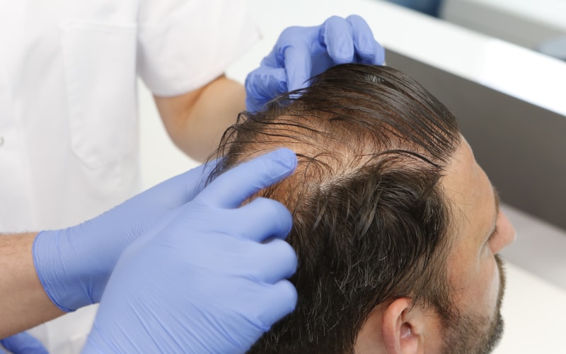 How long does a hair transplant really take to grow?