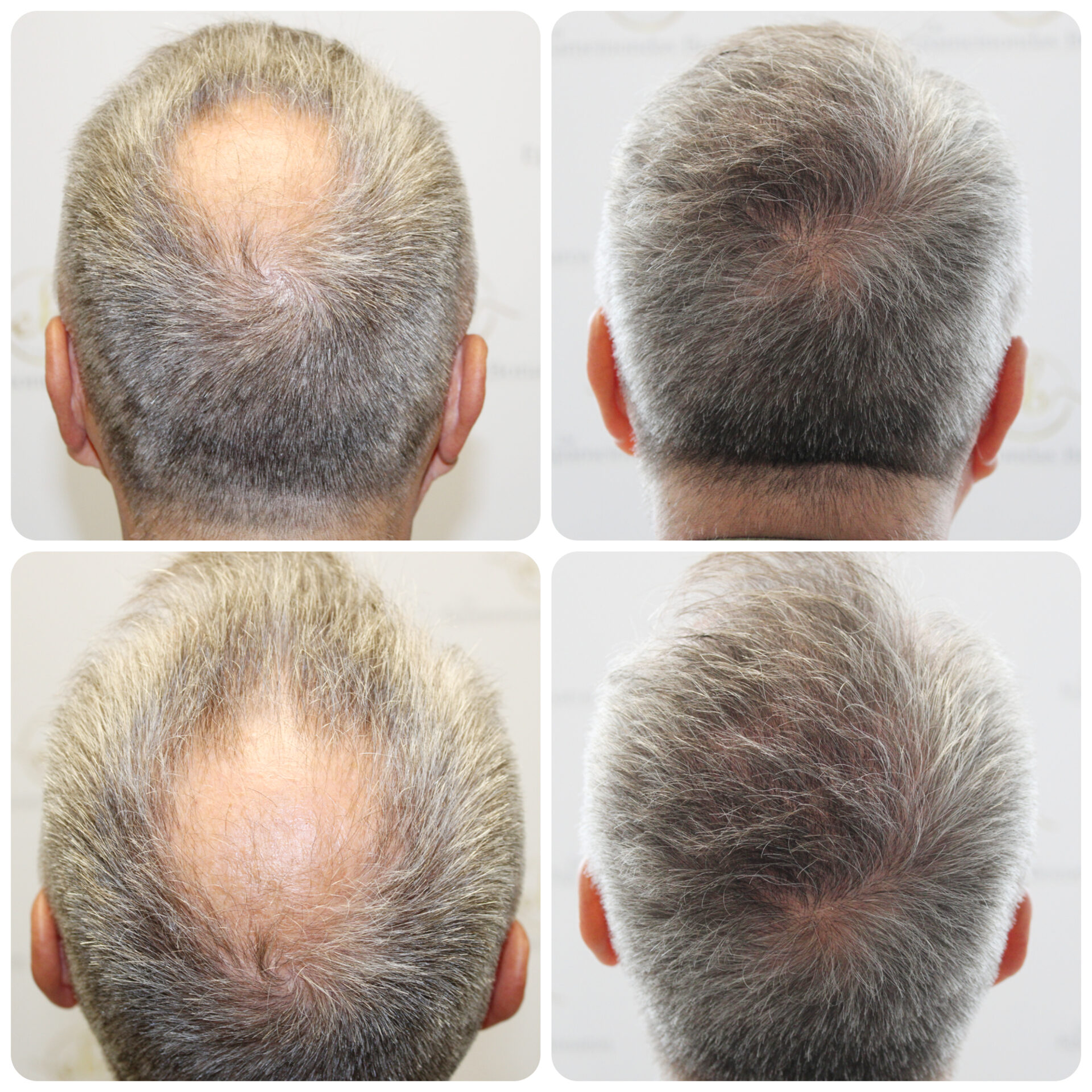 Hair Transplant Case Study: Achieving Full, Natural Crown Coverage for 60-Year Old