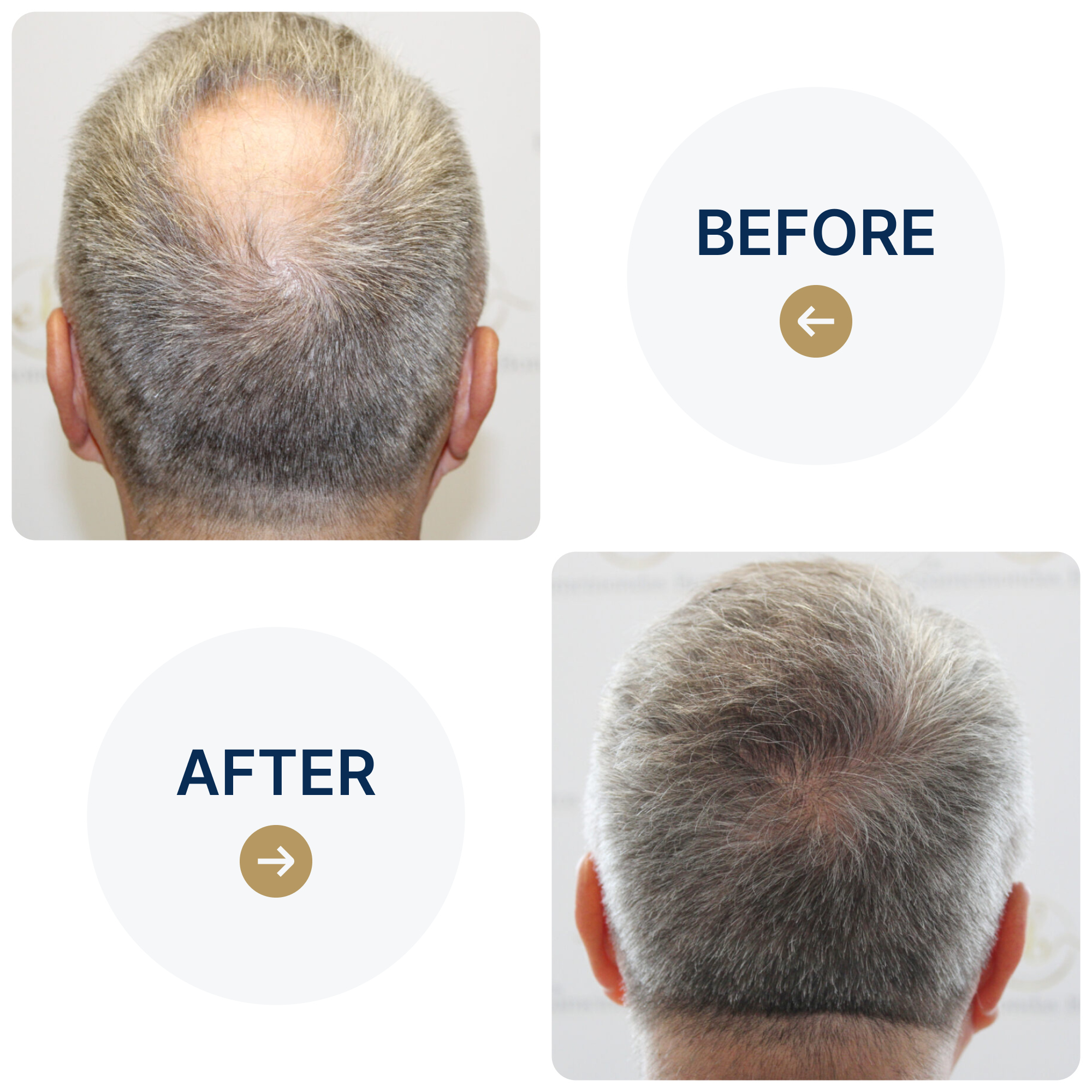 Hair Transplant Case Study: Achieving Full, Natural Crown Coverage for 60-Year Old