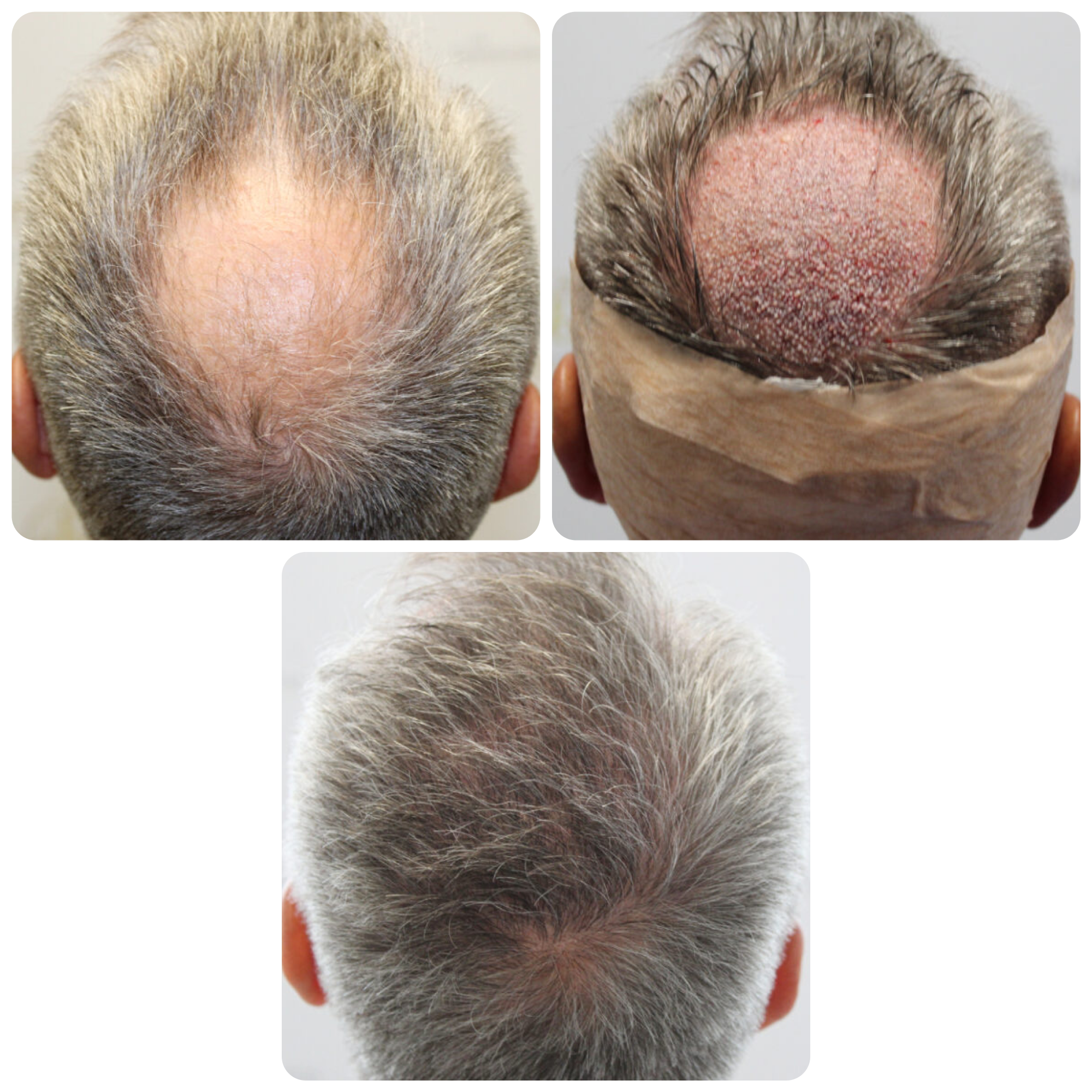 Hair Transplant Case Study: Achieving Full, Natural Crown Coverage for 60-Year Old