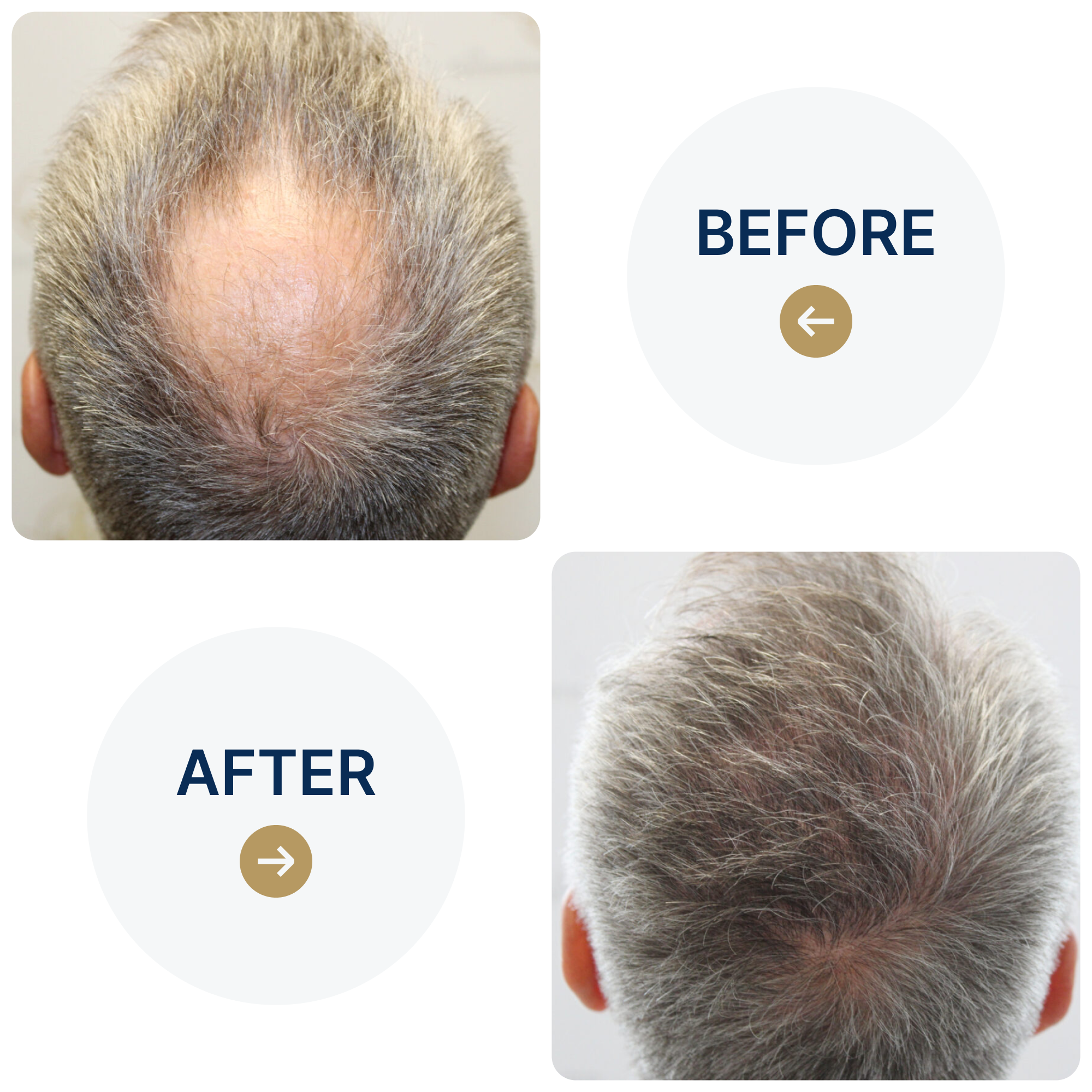 Hair Transplant Case Study: Achieving Full, Natural Crown Coverage for 60-Year Old