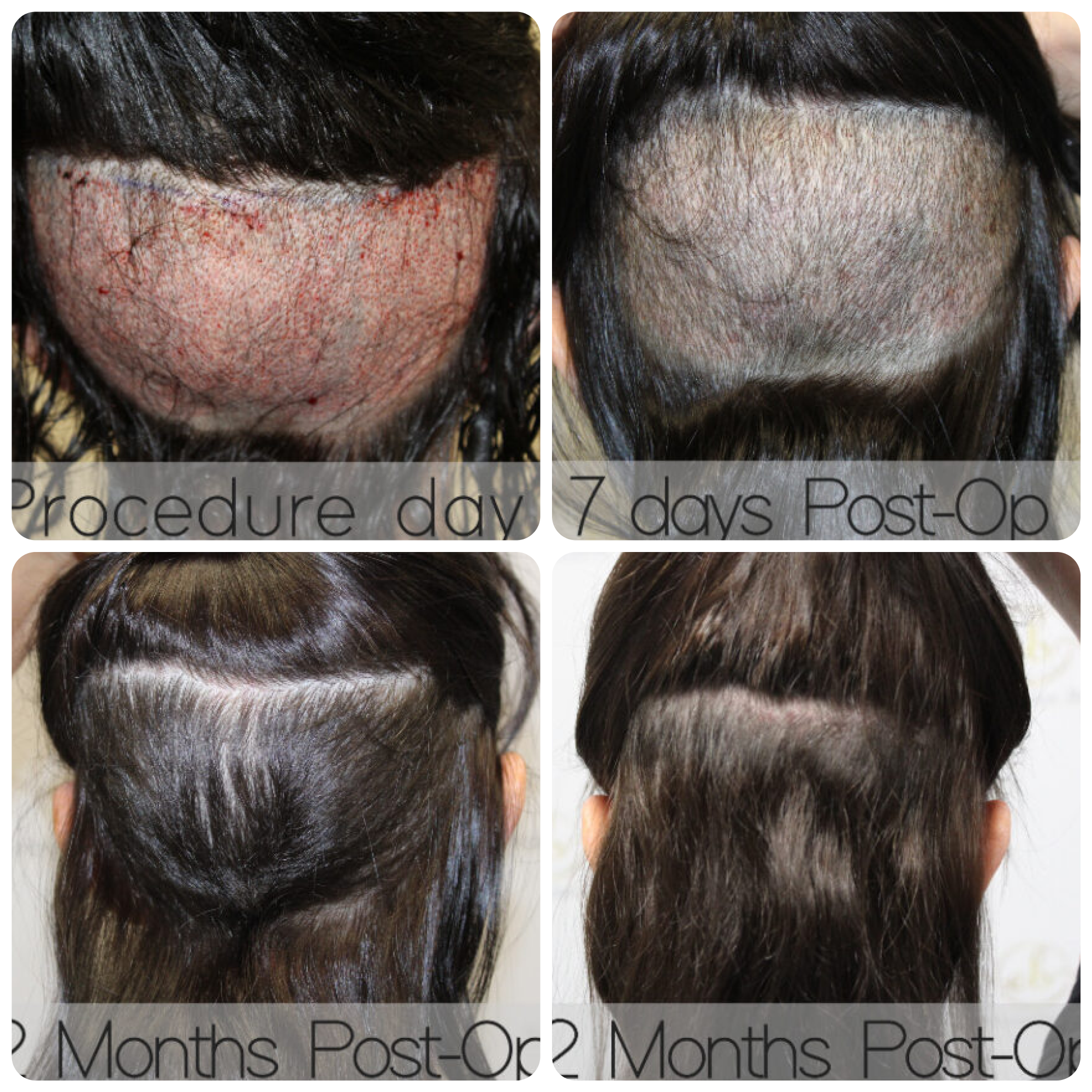 Frontal hair transplant with 1,765 grafts