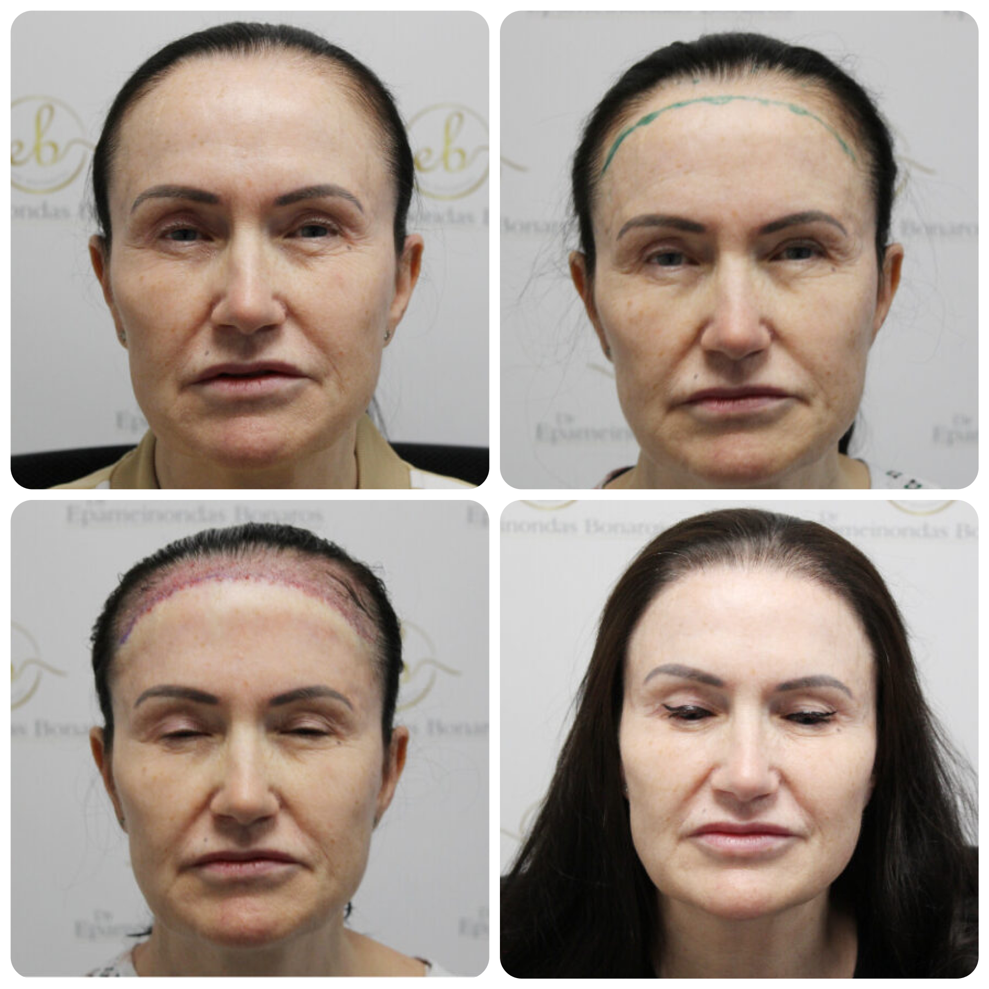 Frontal hair transplant with 1,765 grafts