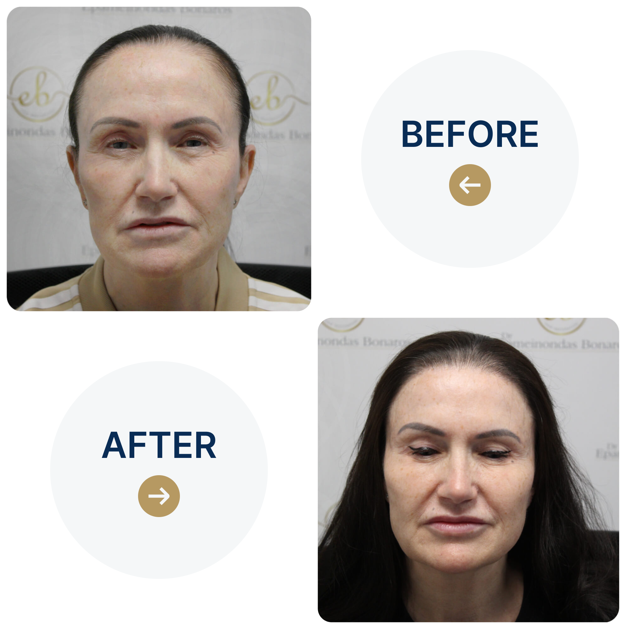 Frontal hair transplant with 1,765 grafts
