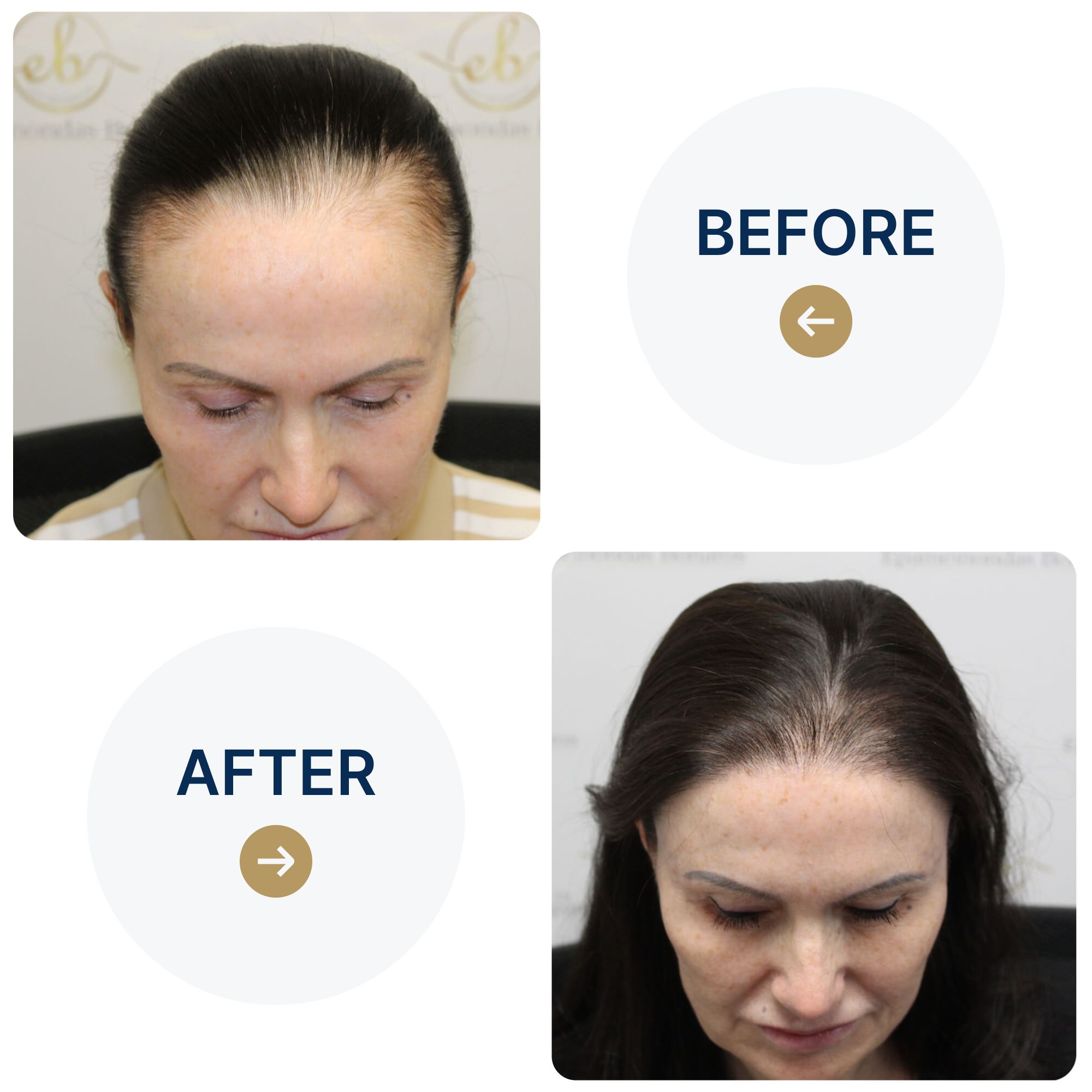 Frontal hair transplant with 1,765 grafts