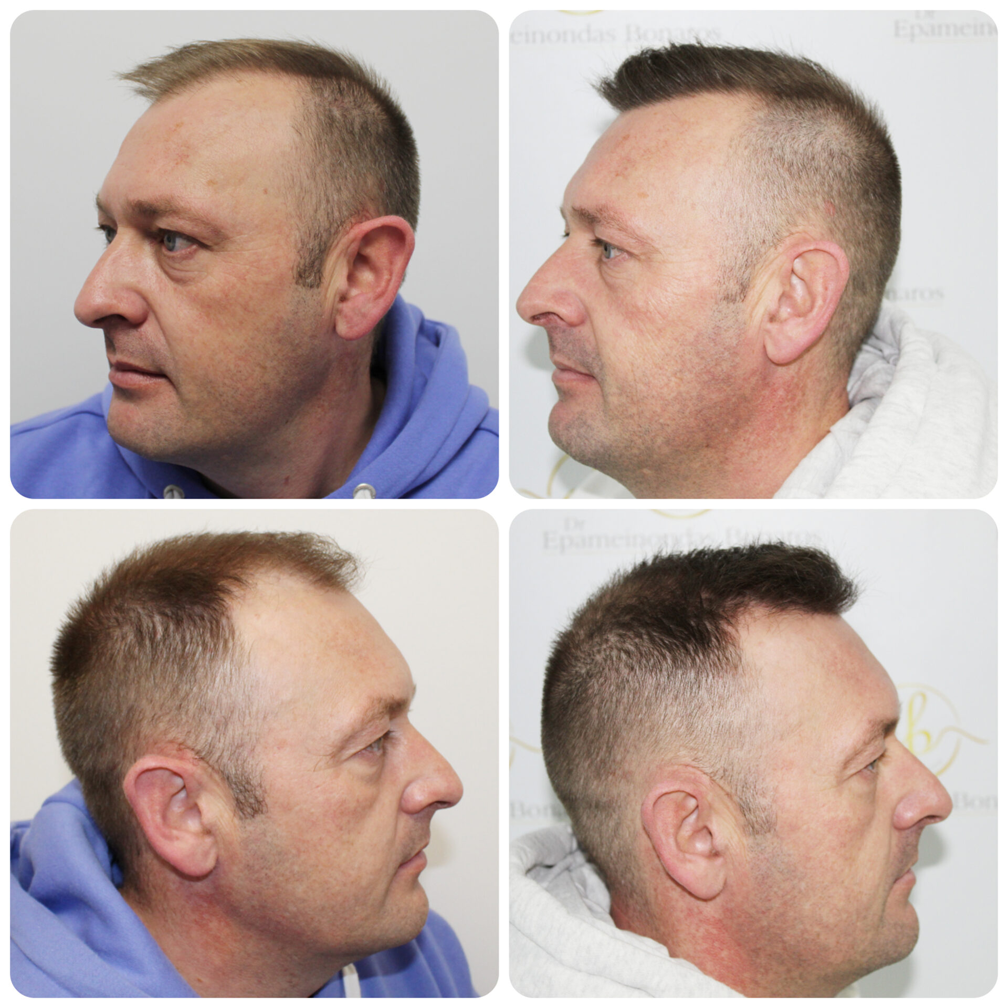FUE hair transplant with 1,814 grafts