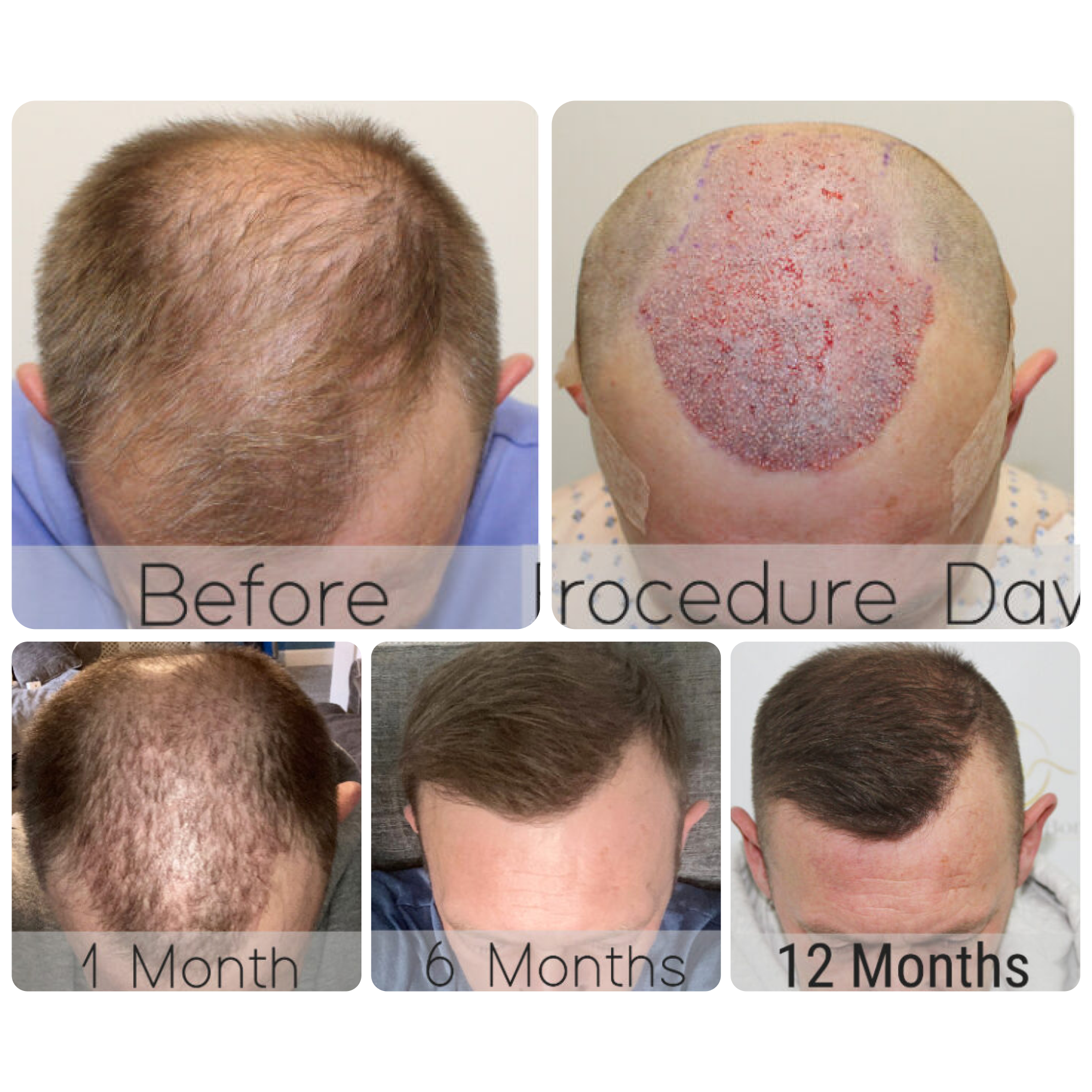 FUE hair transplant with 1,814 grafts
