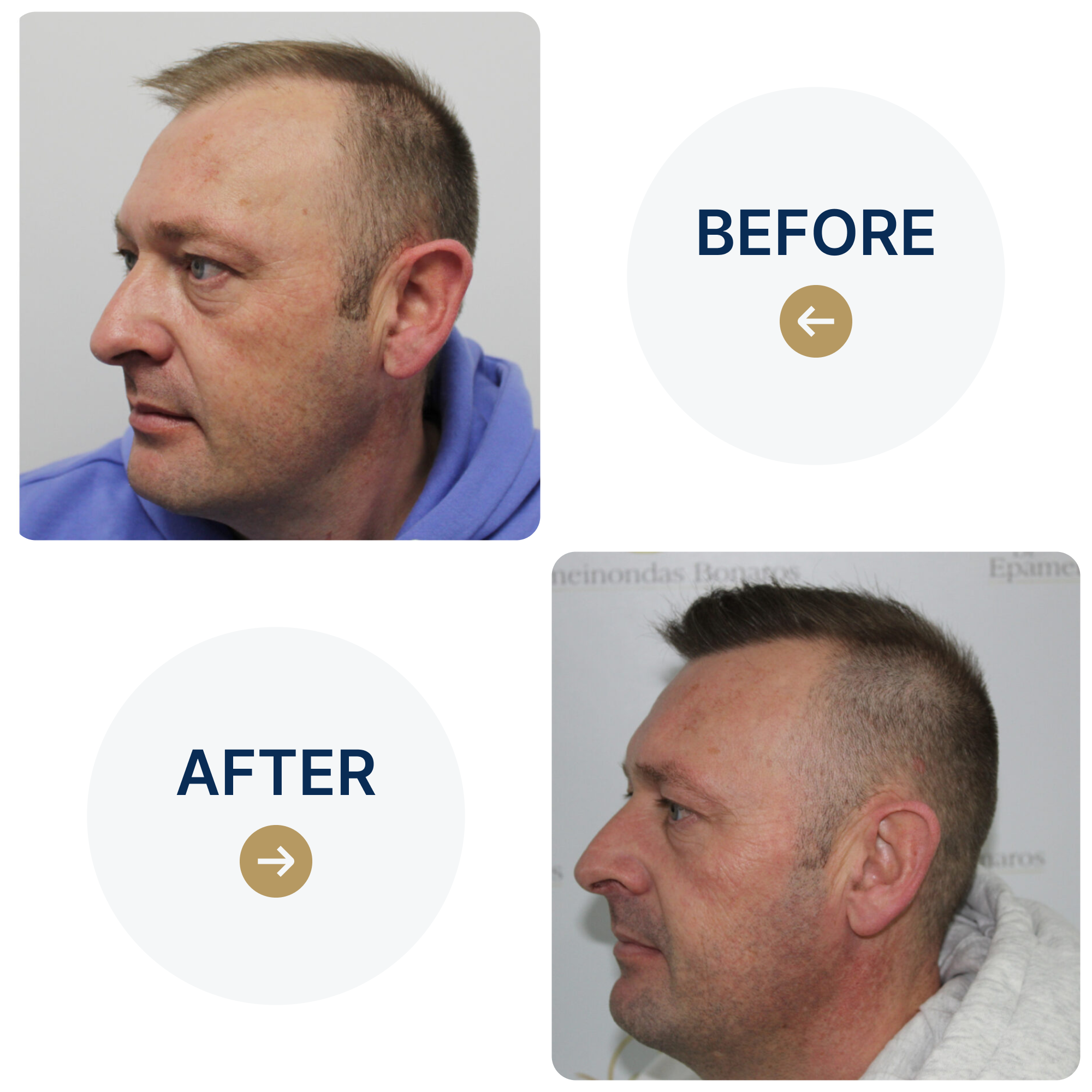 FUE hair transplant with 1,814 grafts