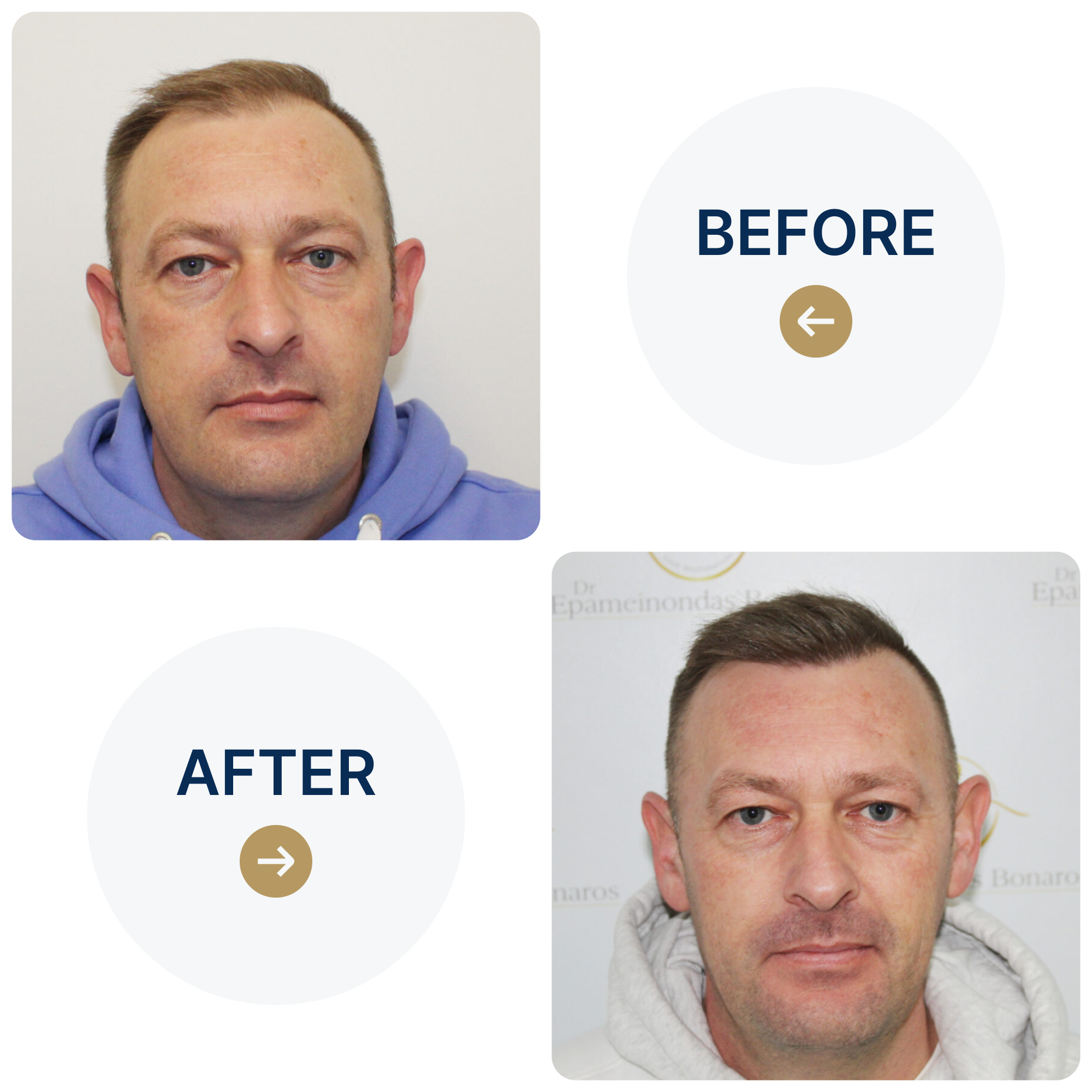 FUE hair transplant with 1,814 grafts