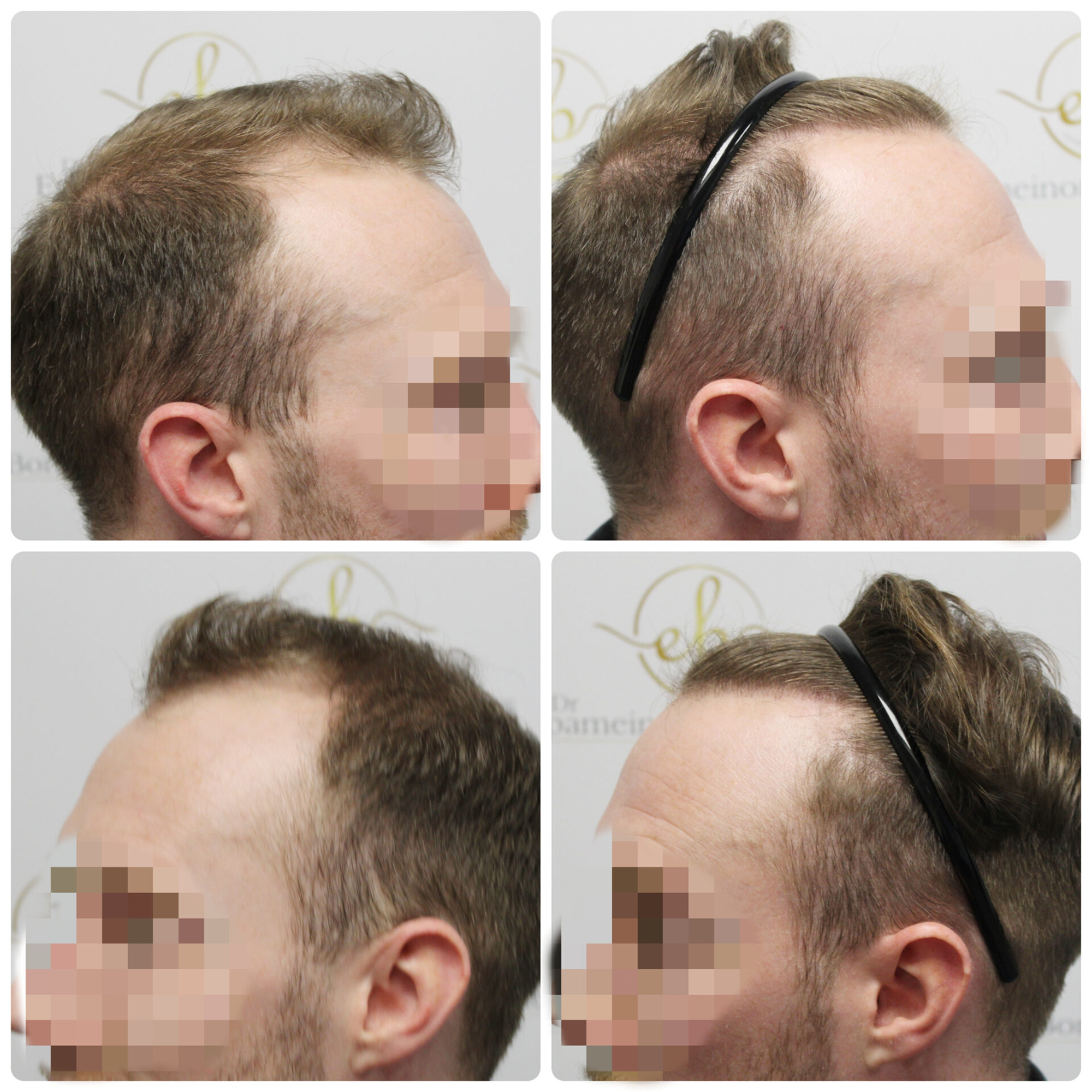 FUE hair transplant with 1,819 grafts