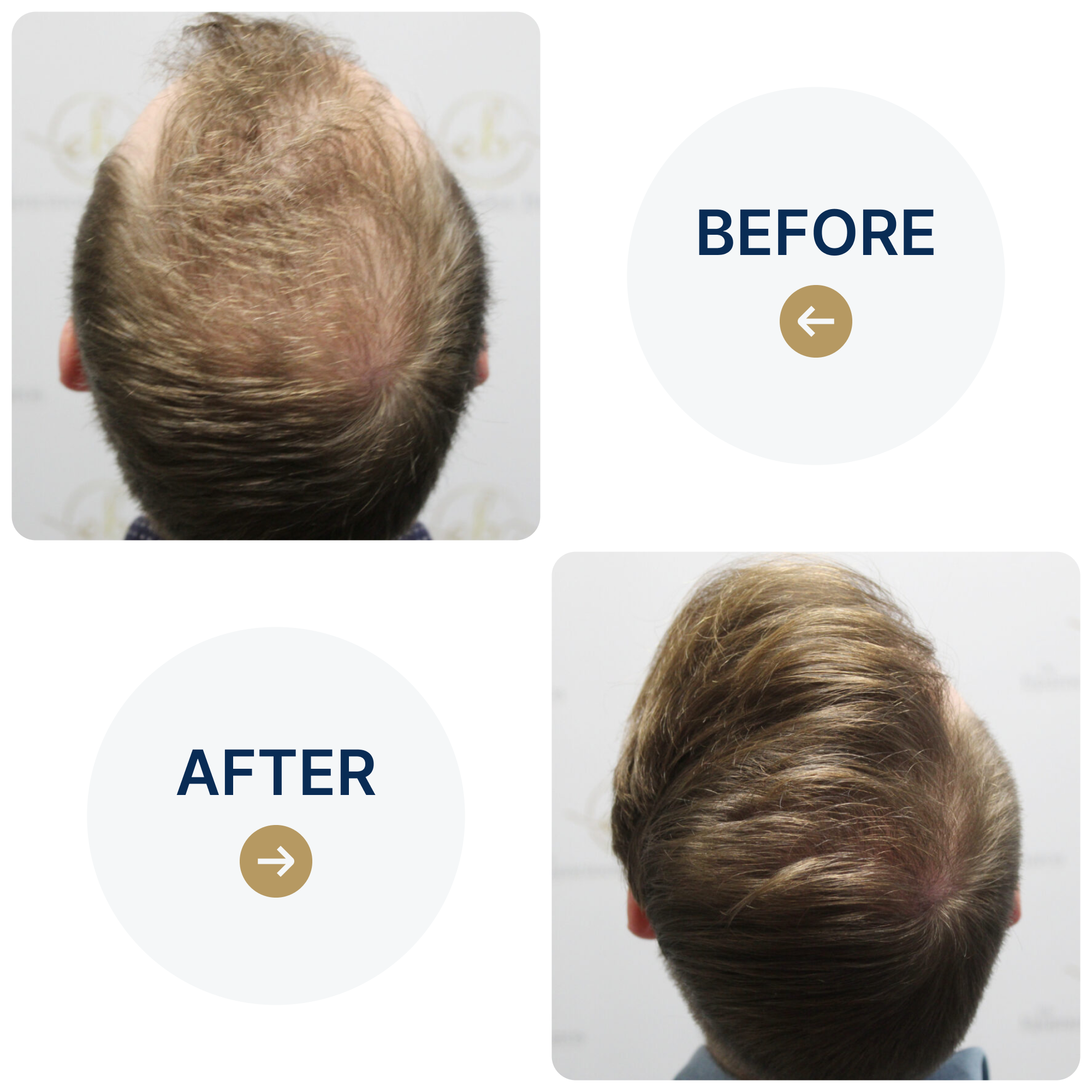 FUE hair transplant with 1,819 grafts