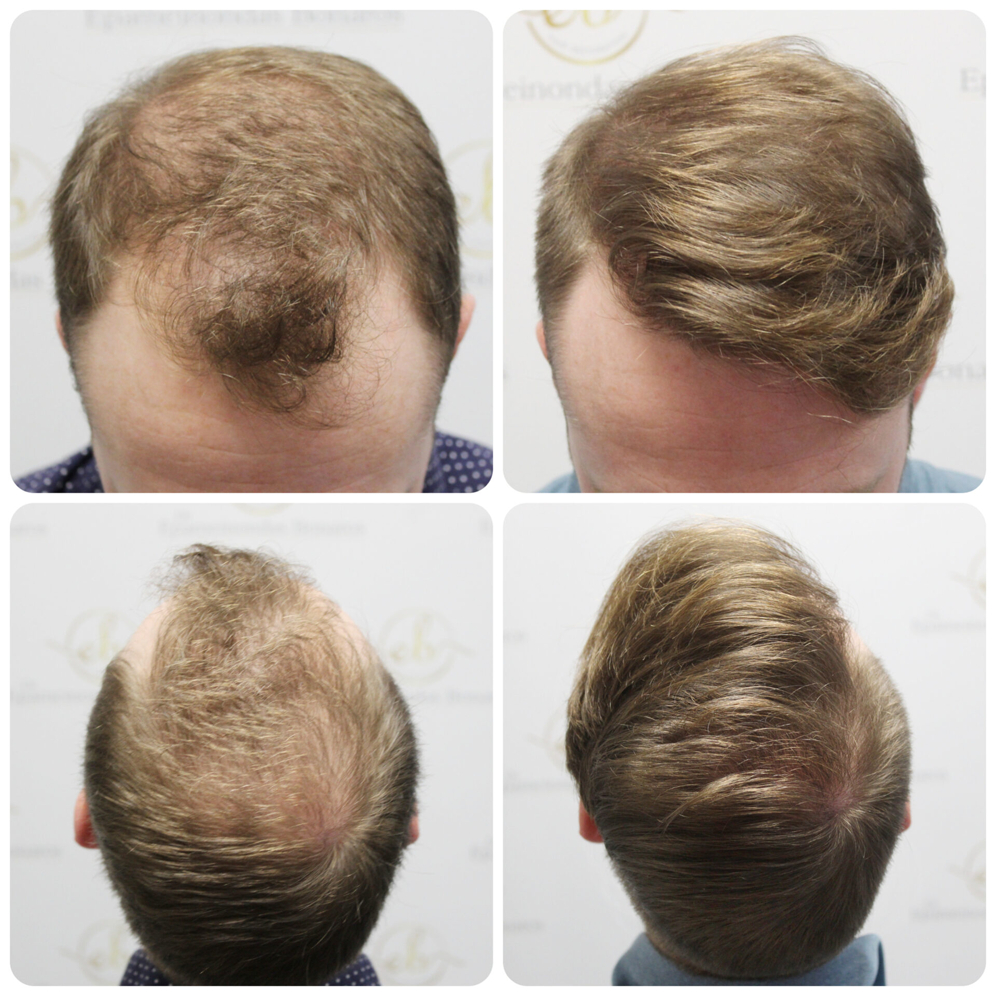 FUE hair transplant with 1,819 grafts