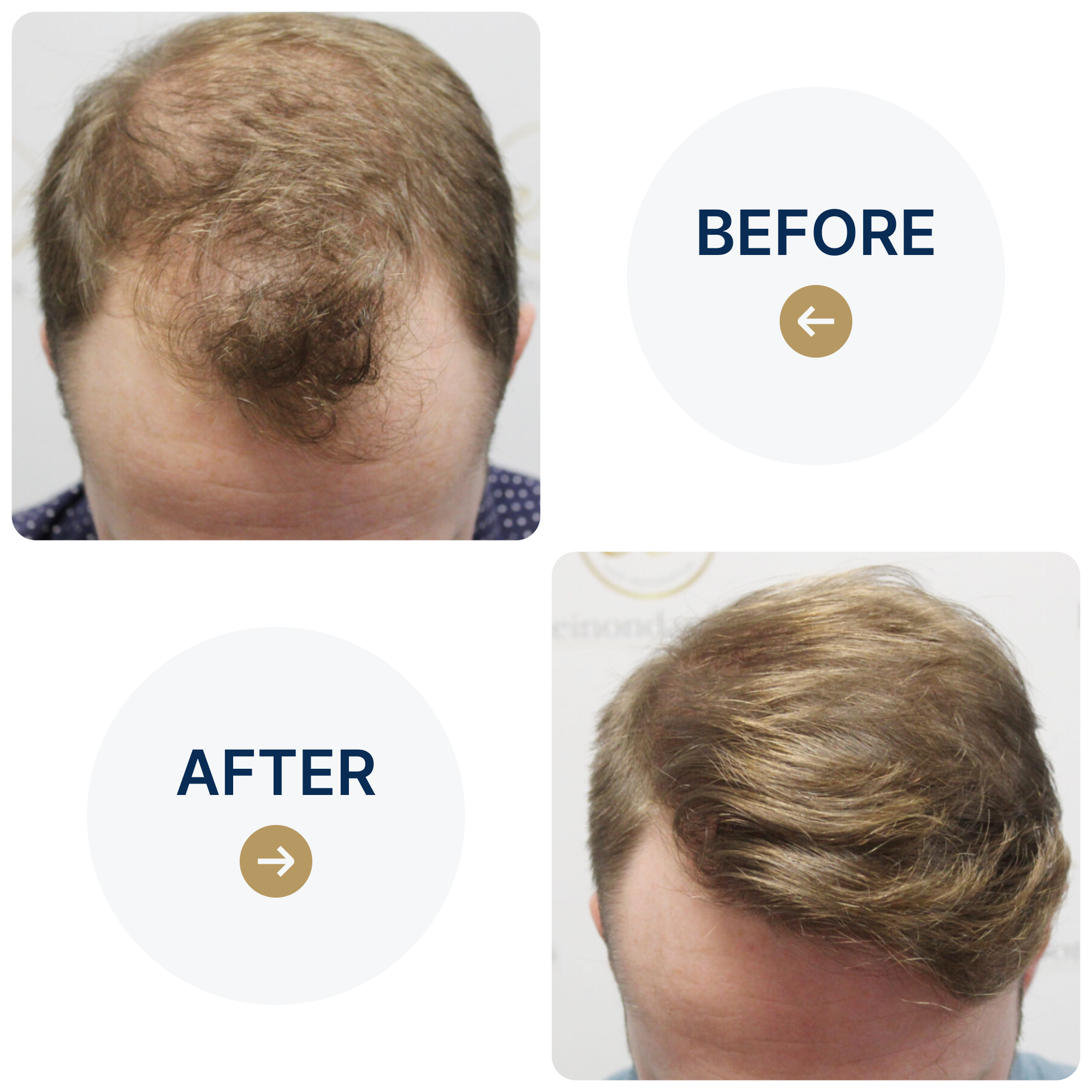 FUE hair transplant with 1,819 grafts