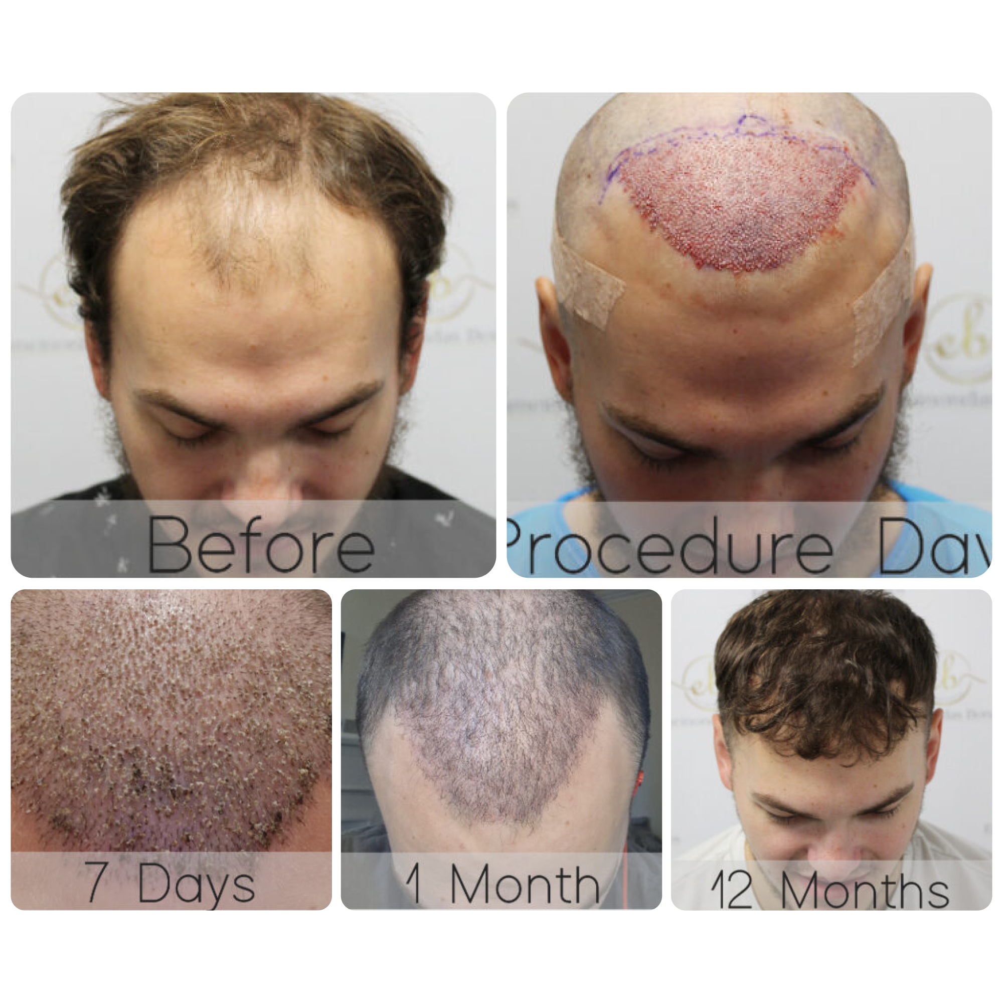 FUE procedure with 2,003 grafts