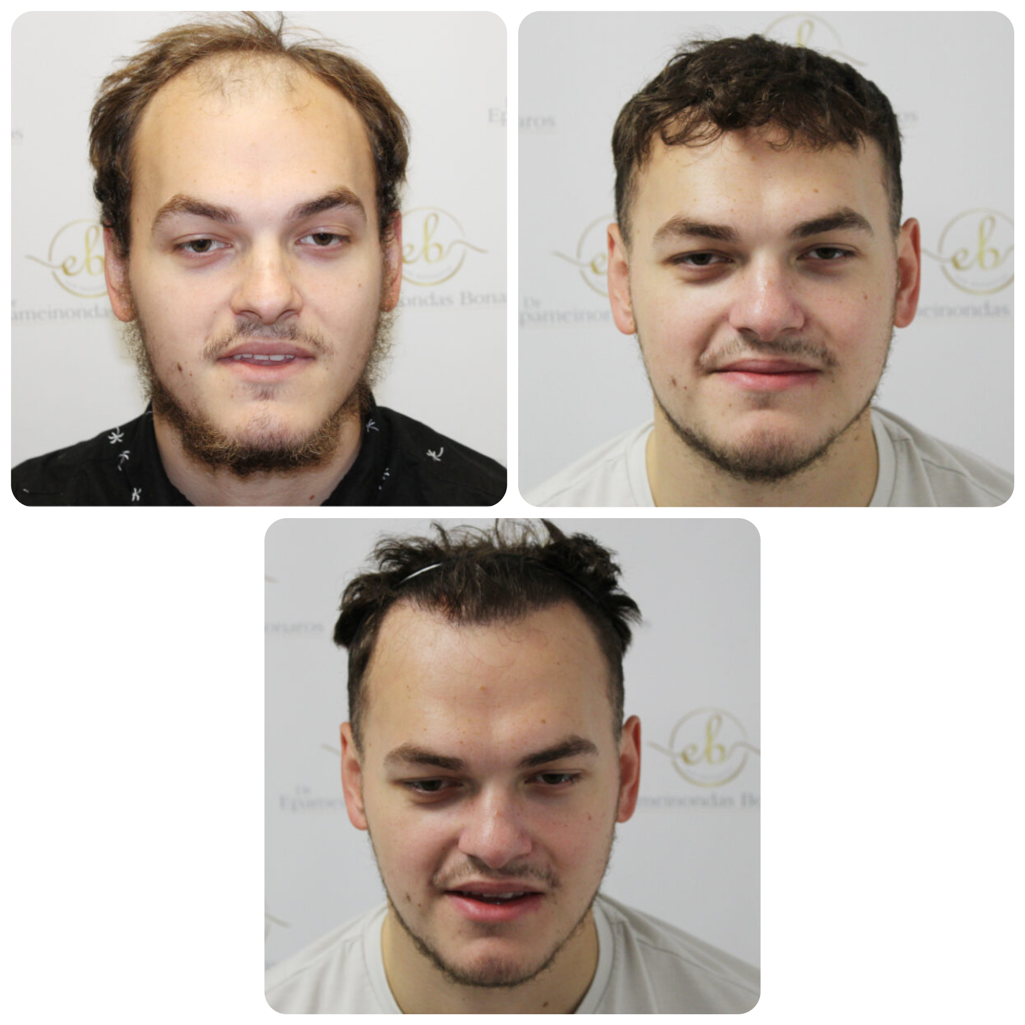 FUE procedure with 2,003 grafts