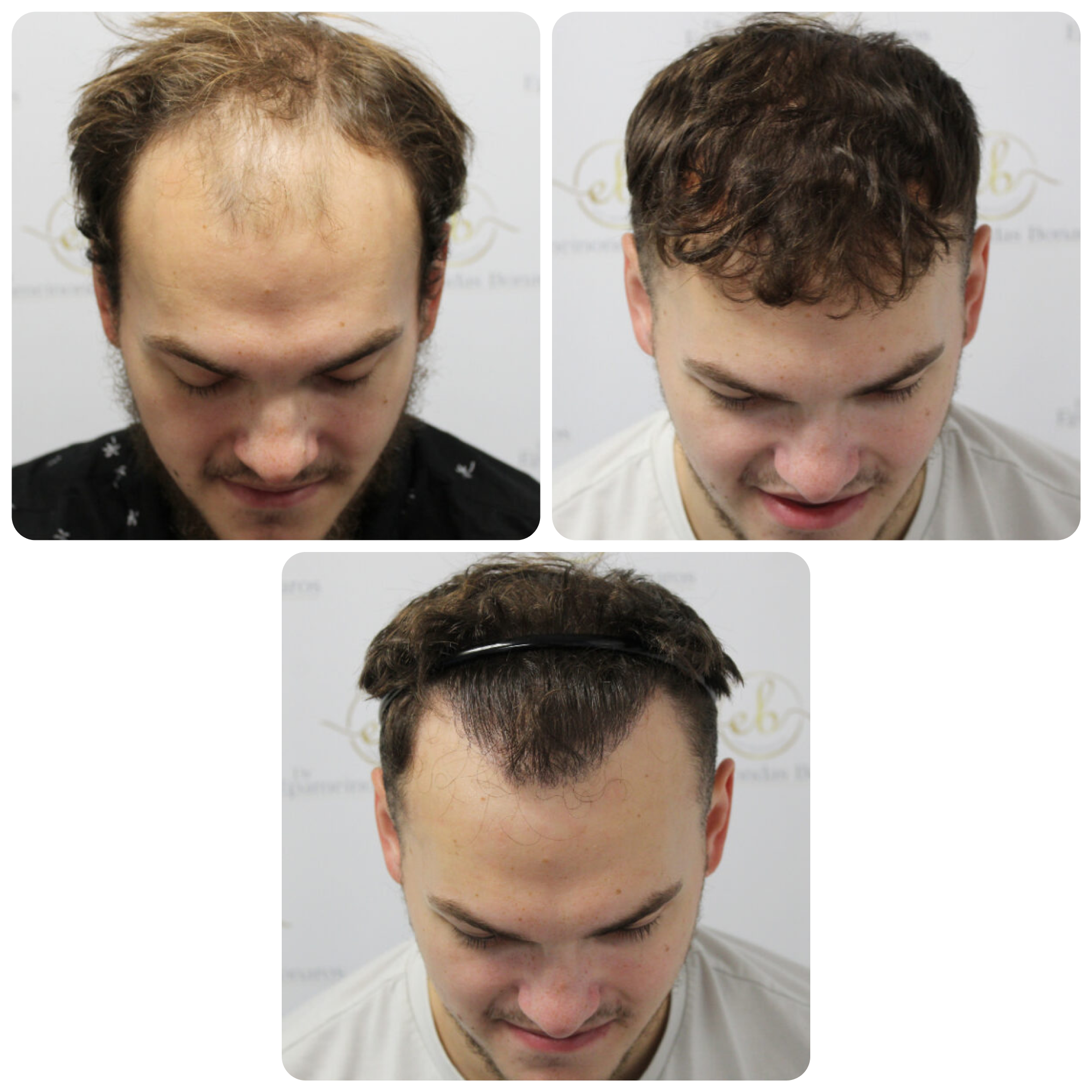FUE procedure with 2,003 grafts
