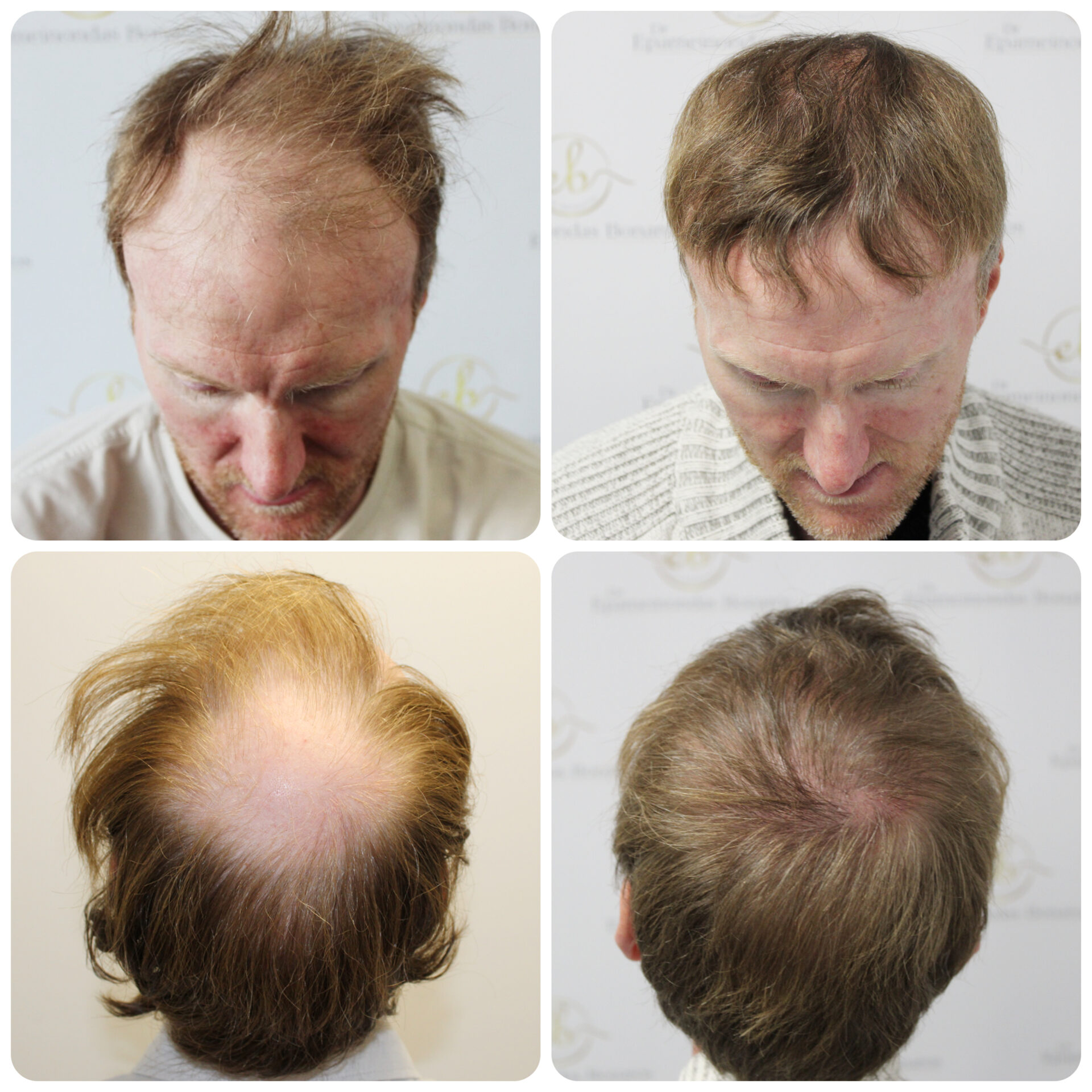 FUE procedure with 2,016 grafts