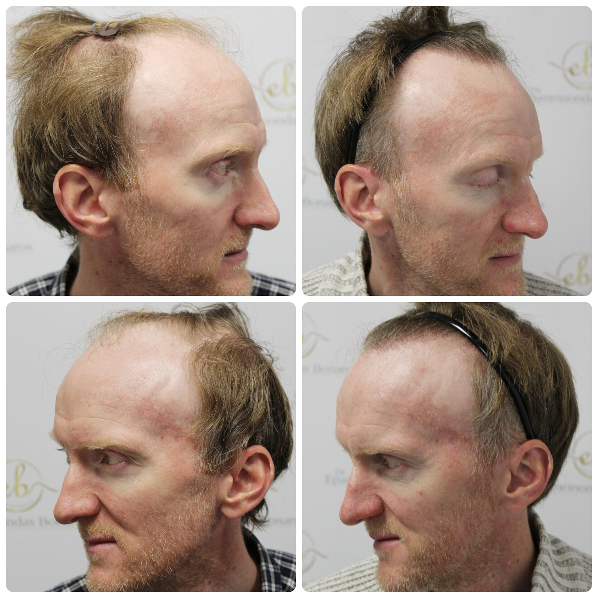 FUE procedure with 2,016 grafts