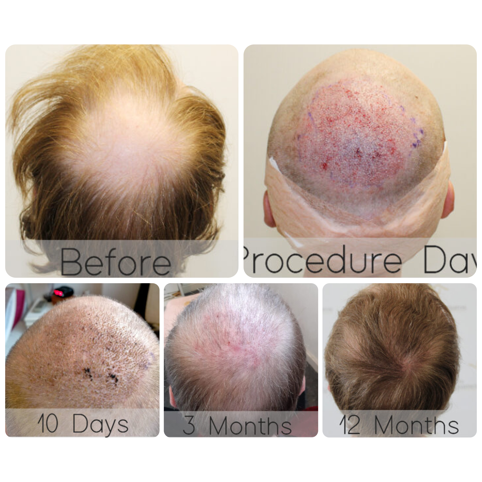 FUE procedure with 2,016 grafts