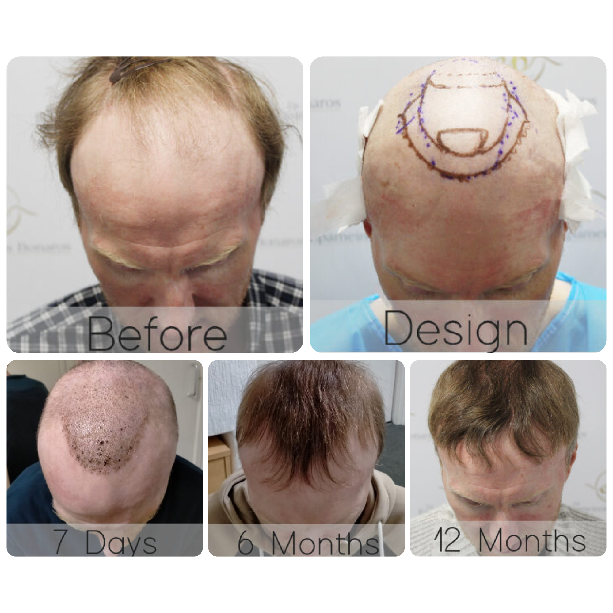FUE procedure with 2,016 grafts