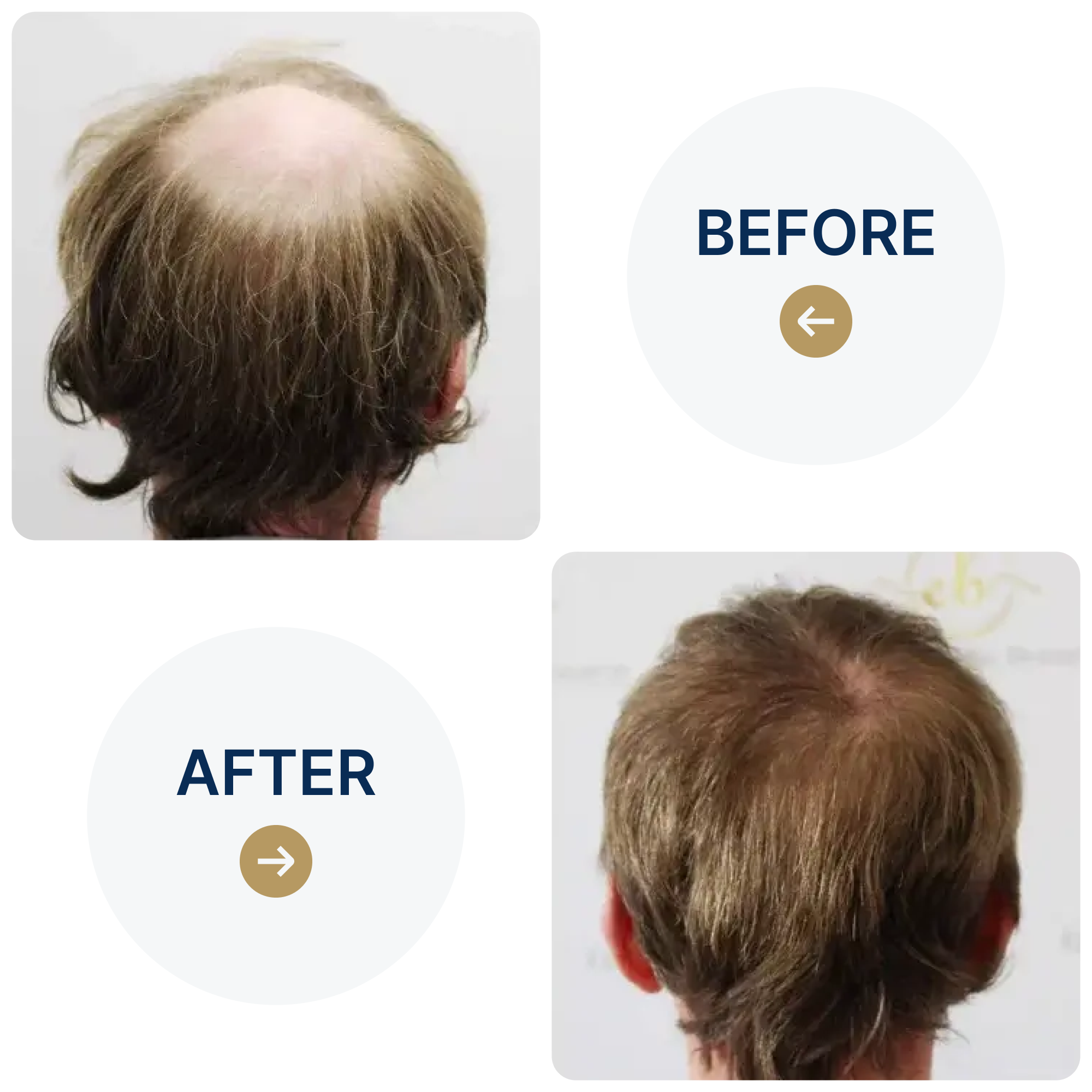 FUE procedure with 2,016 grafts