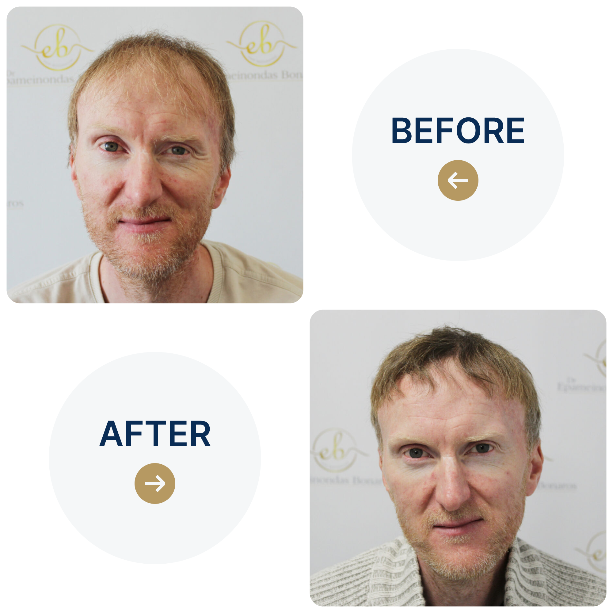 FUE procedure with 2,016 grafts