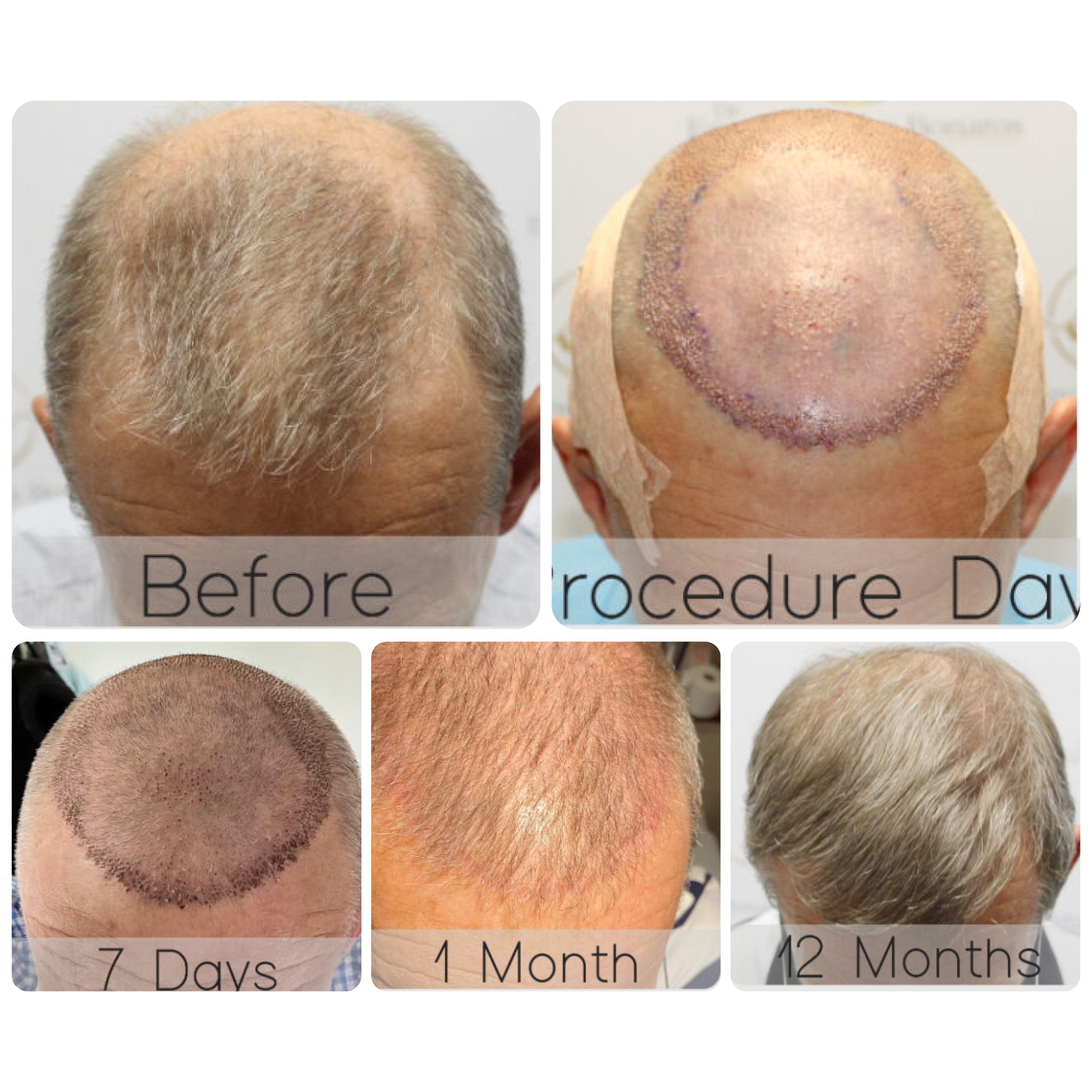 FUE procedure with 3,102 grafts