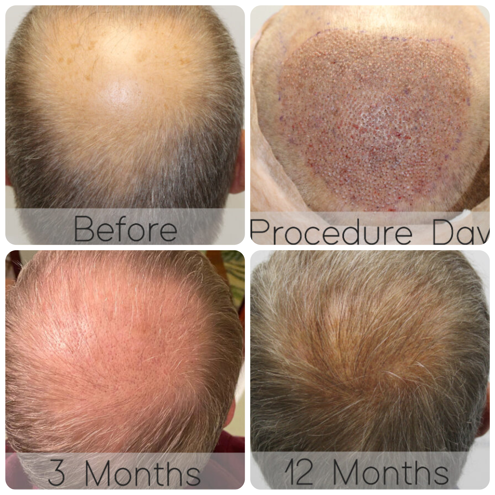 FUE procedure with 3,102 grafts