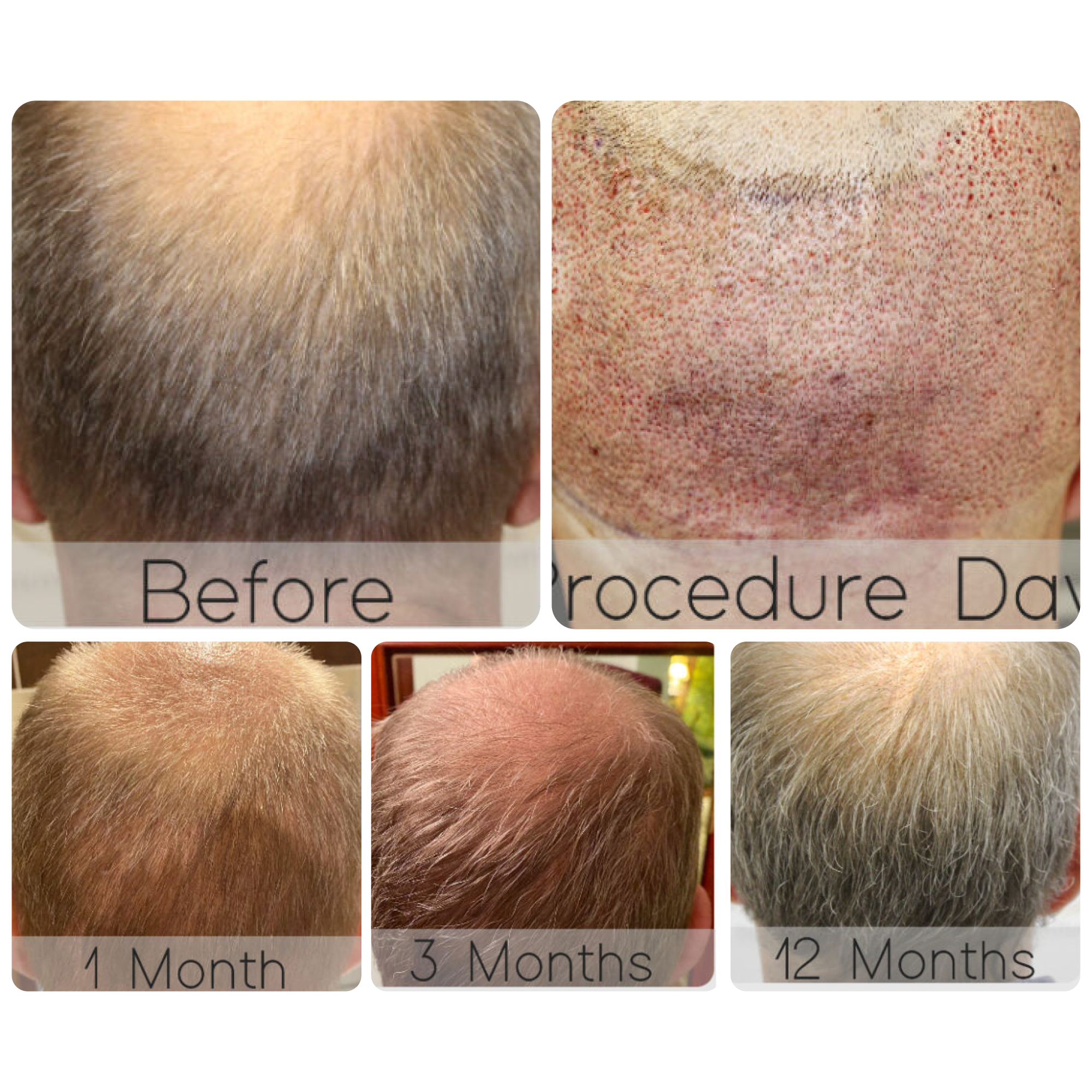 FUE procedure with 3,102 grafts