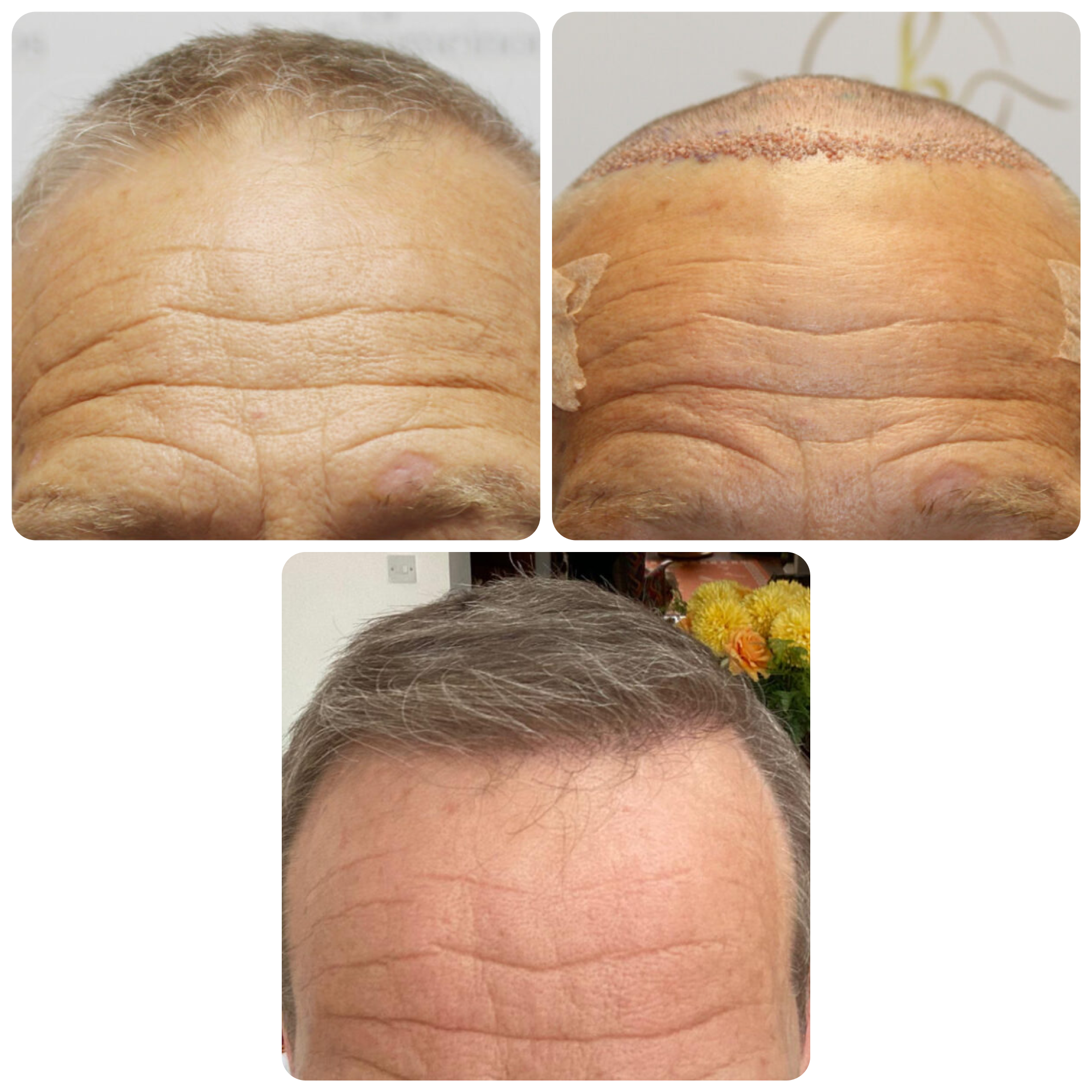 FUE procedure with 3,102 grafts