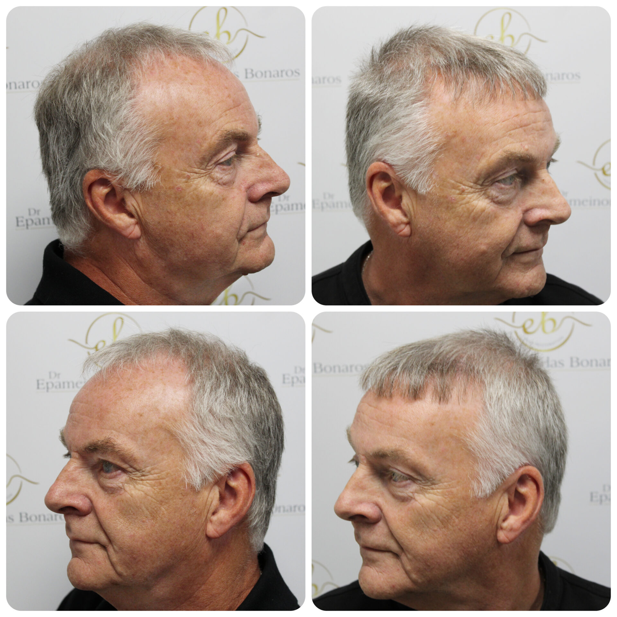 FUE procedure with 3,413 grafts