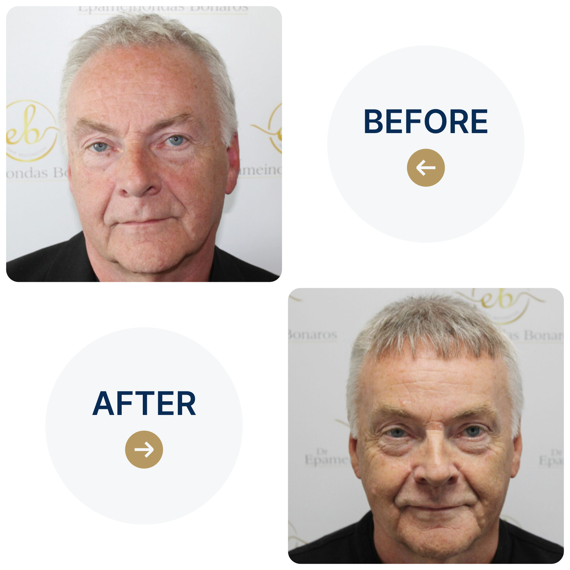 FUE procedure with 3,413 grafts