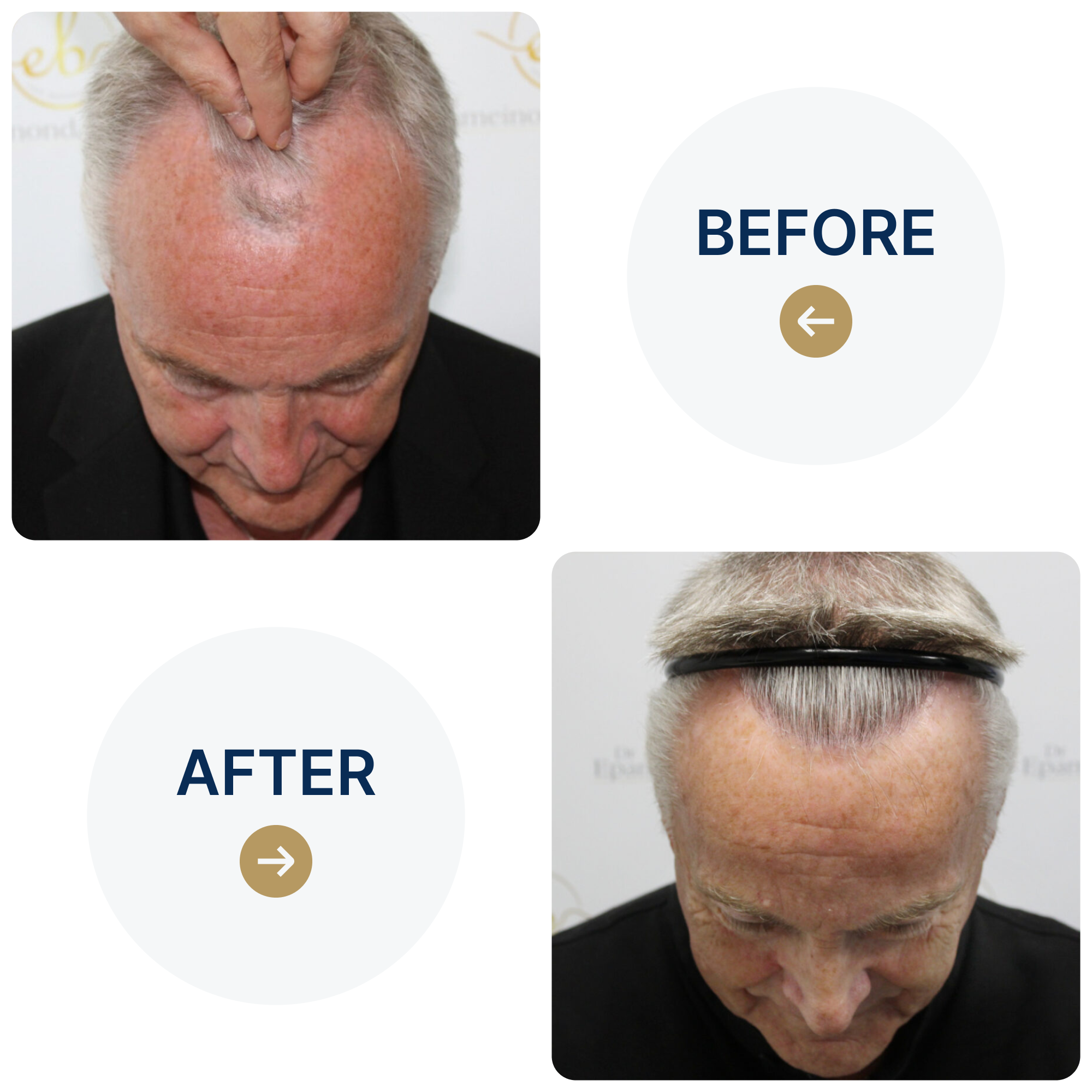 FUE procedure with 3,413 grafts