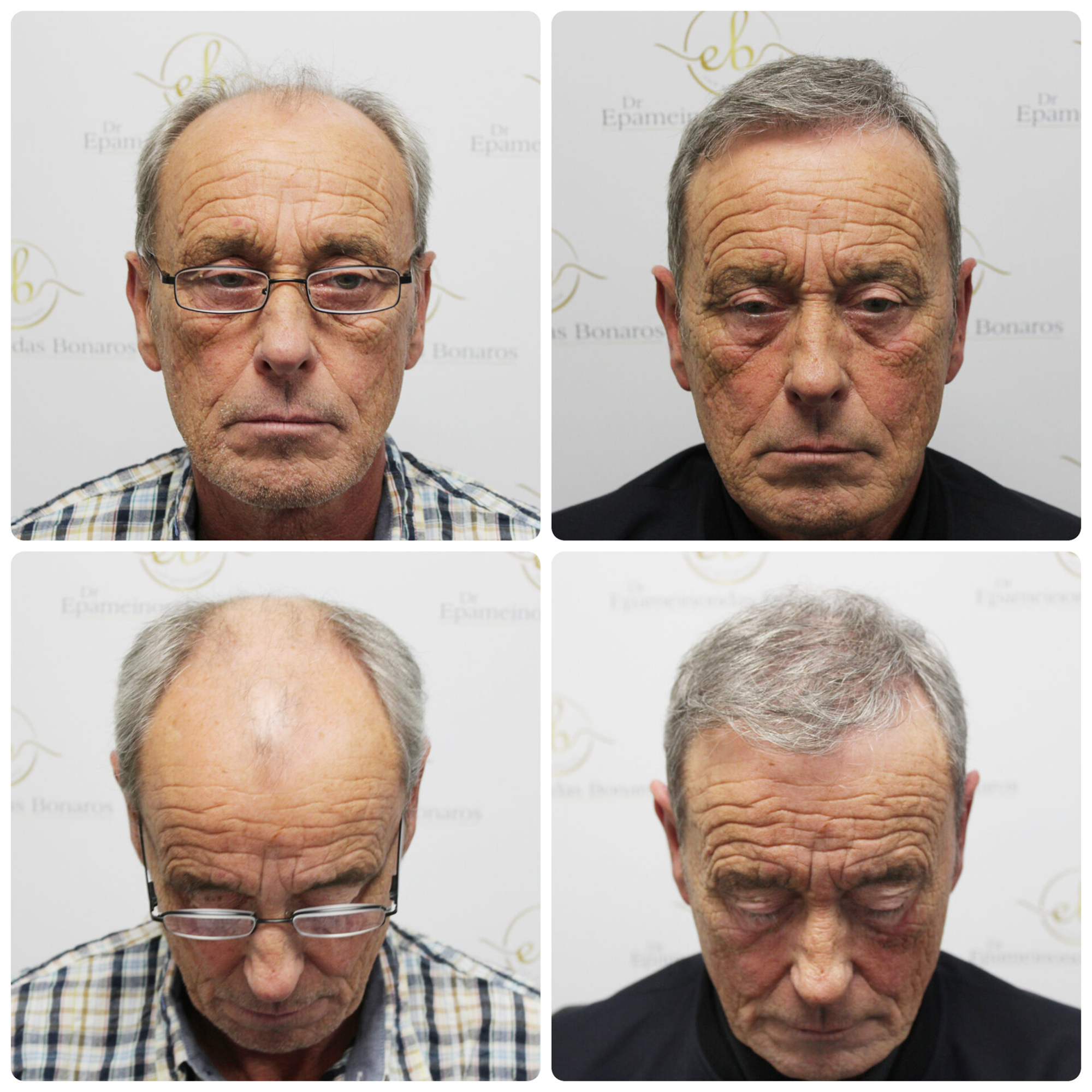 FUE hair transplant with 3,524 grafts
