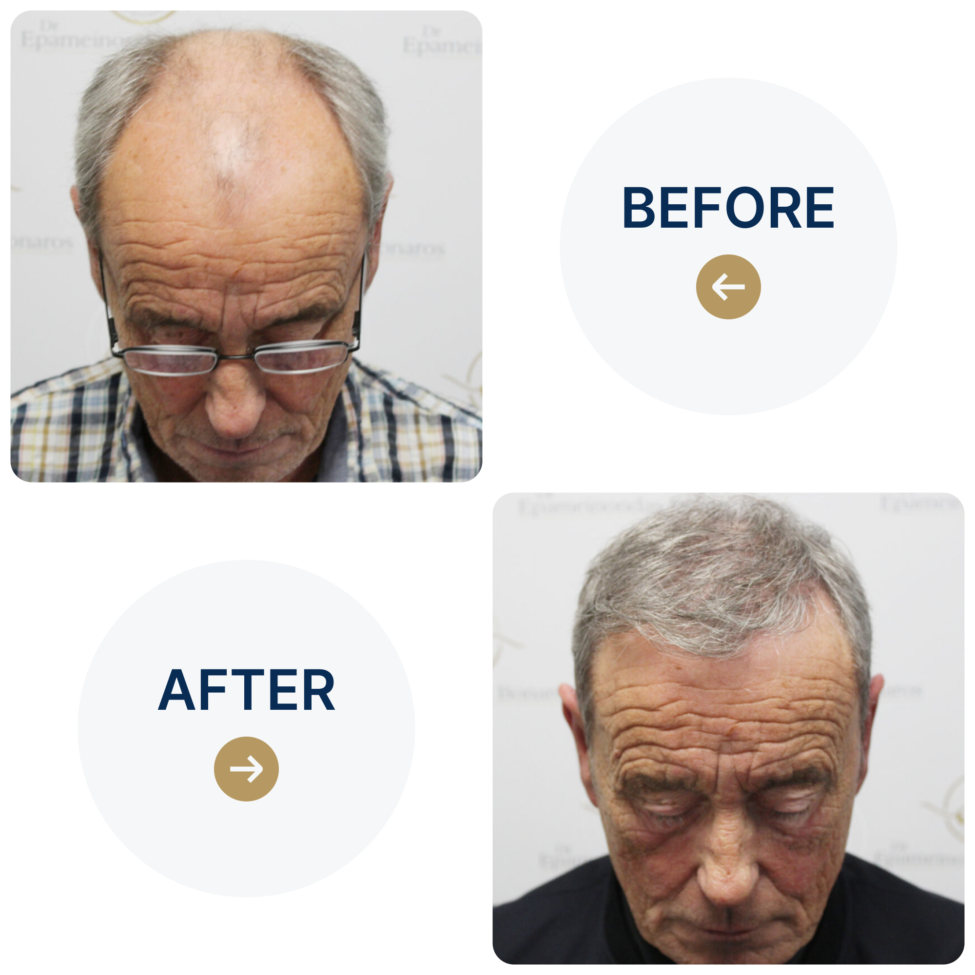 FUE hair transplant with 3,524 grafts