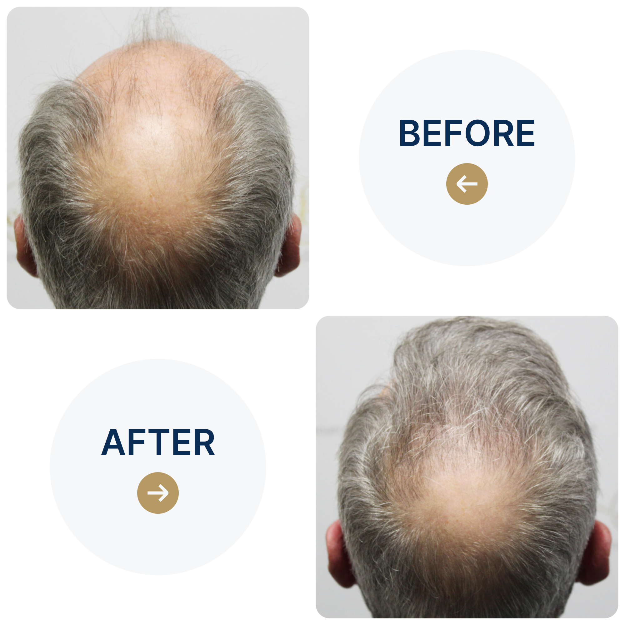 FUE hair transplant with 3,524 grafts
