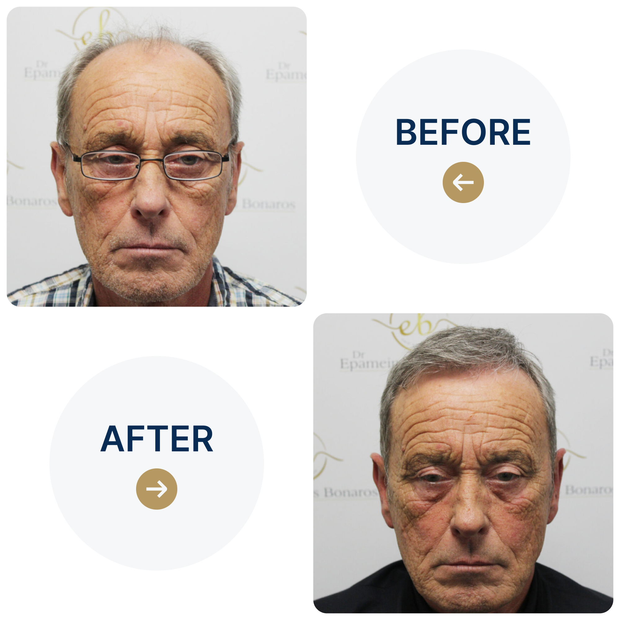 FUE hair transplant with 3,524 grafts