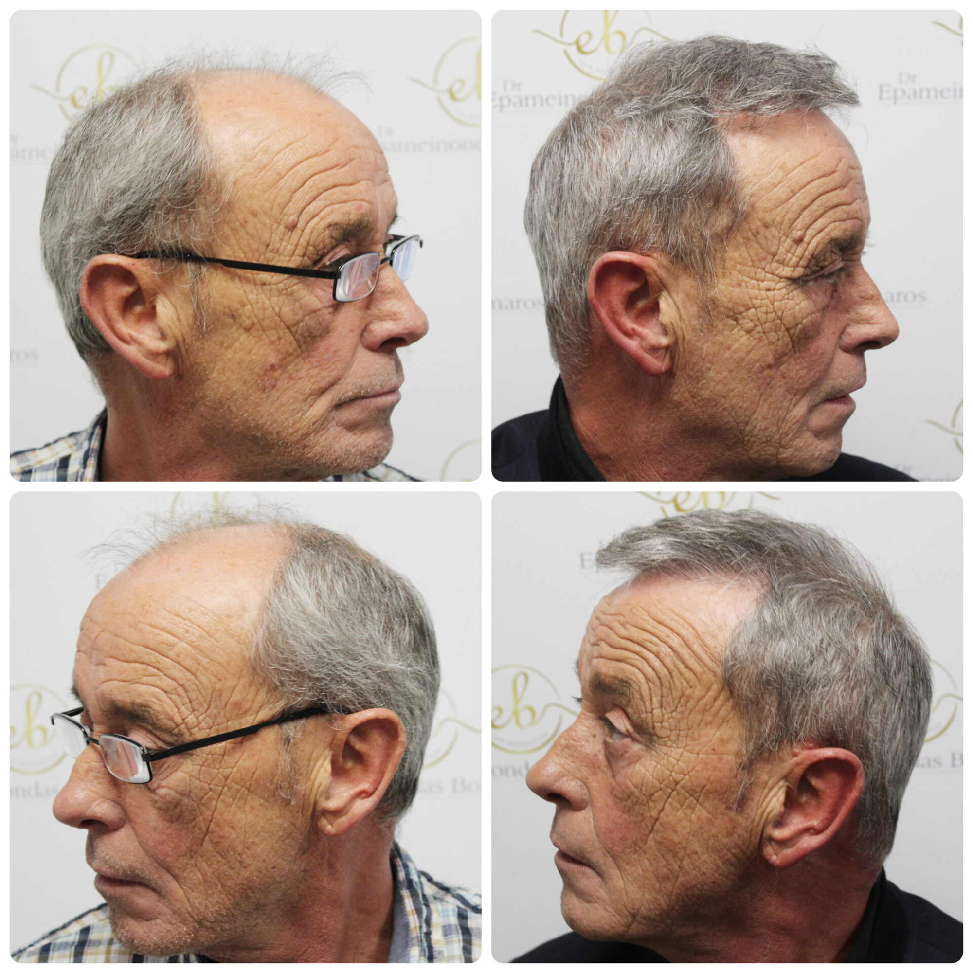 FUE hair transplant with 3,524 grafts