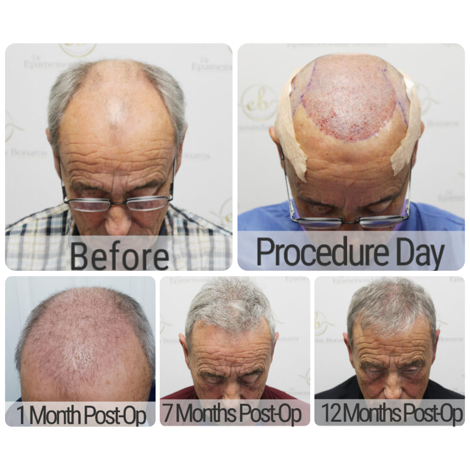 FUE hair transplant with 3,524 grafts