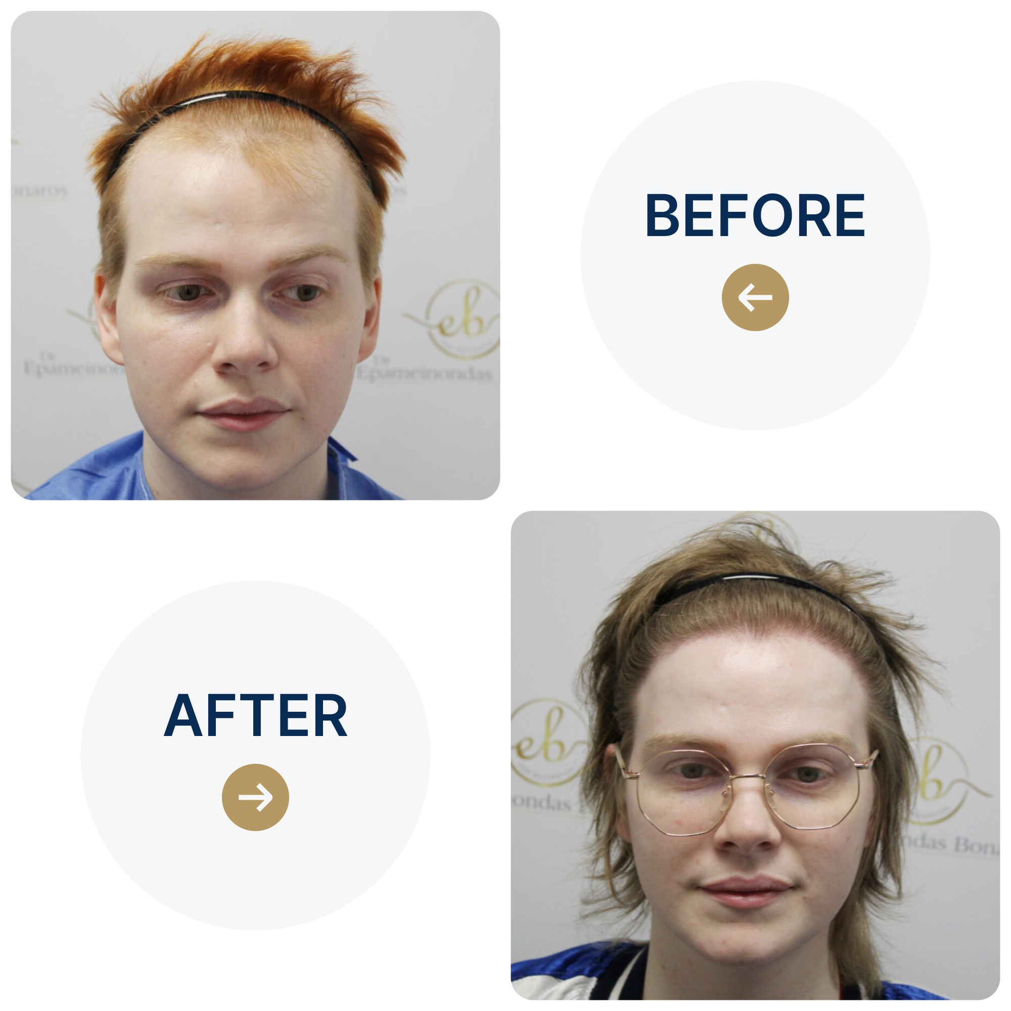 FUE hair transplant with 3,600 grafts