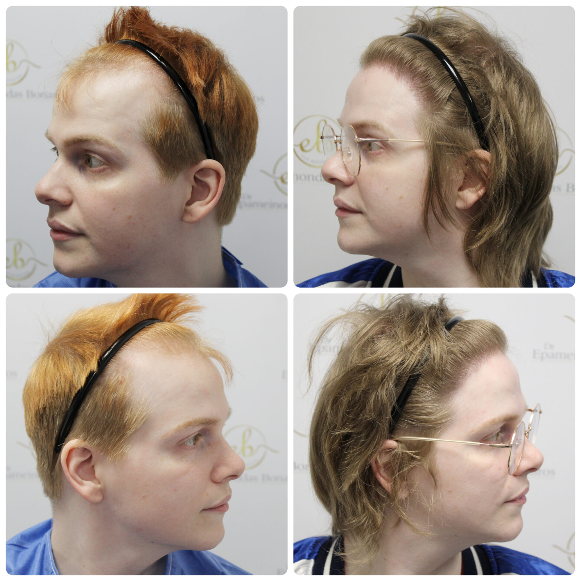 FUE hair transplant with 3,600 grafts