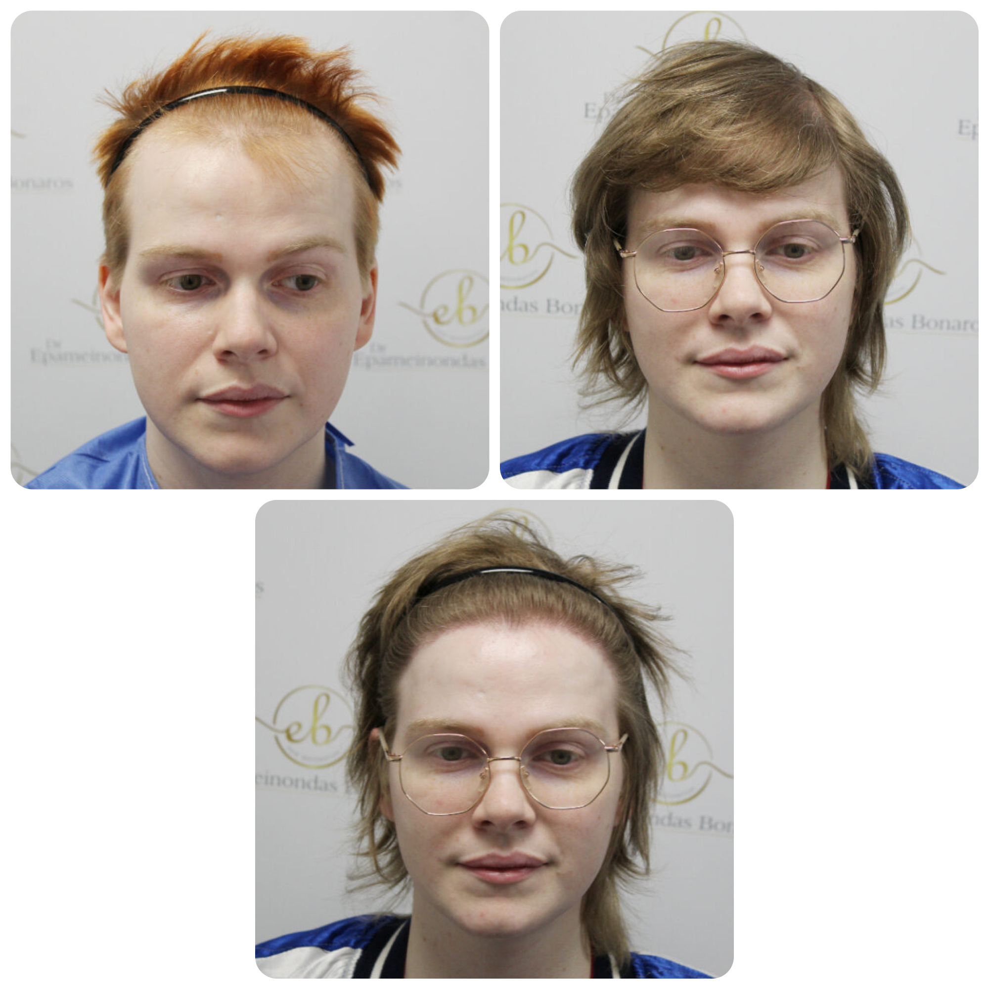 FUE hair transplant with 3,600 grafts