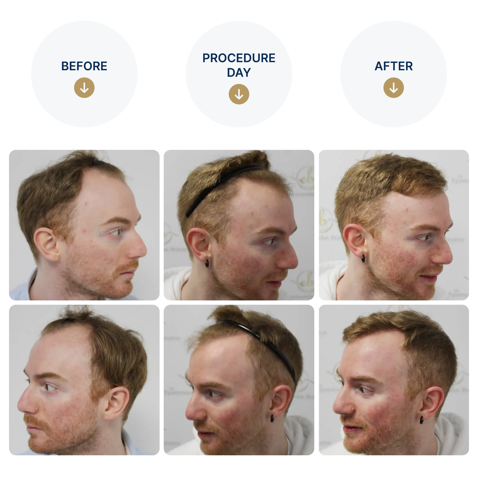 FUE procedure with 3,641 grafts