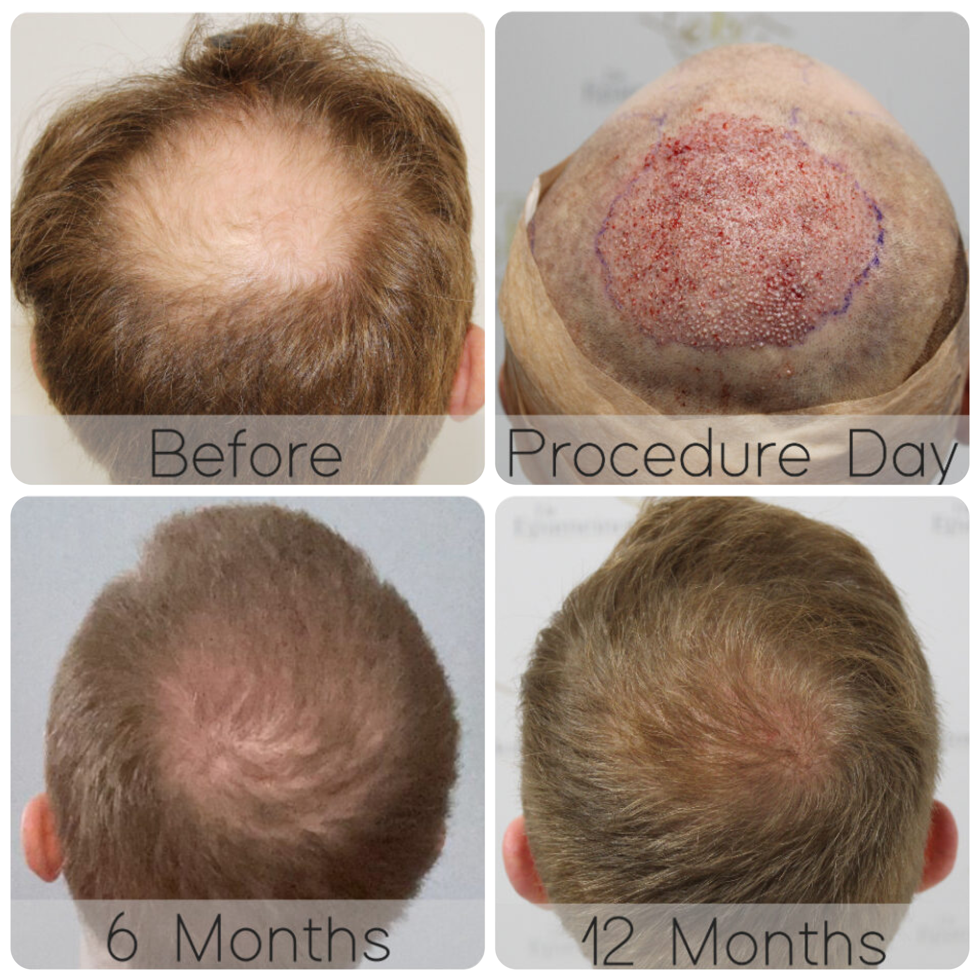FUE procedure with 3,641 grafts