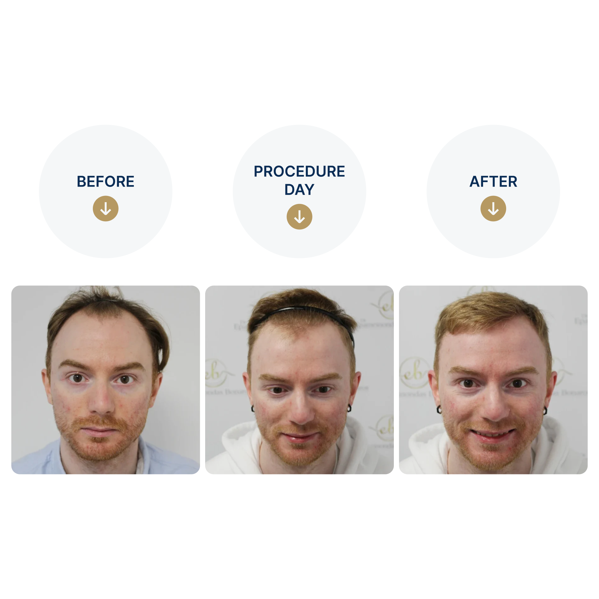 FUE procedure with 3,641 grafts