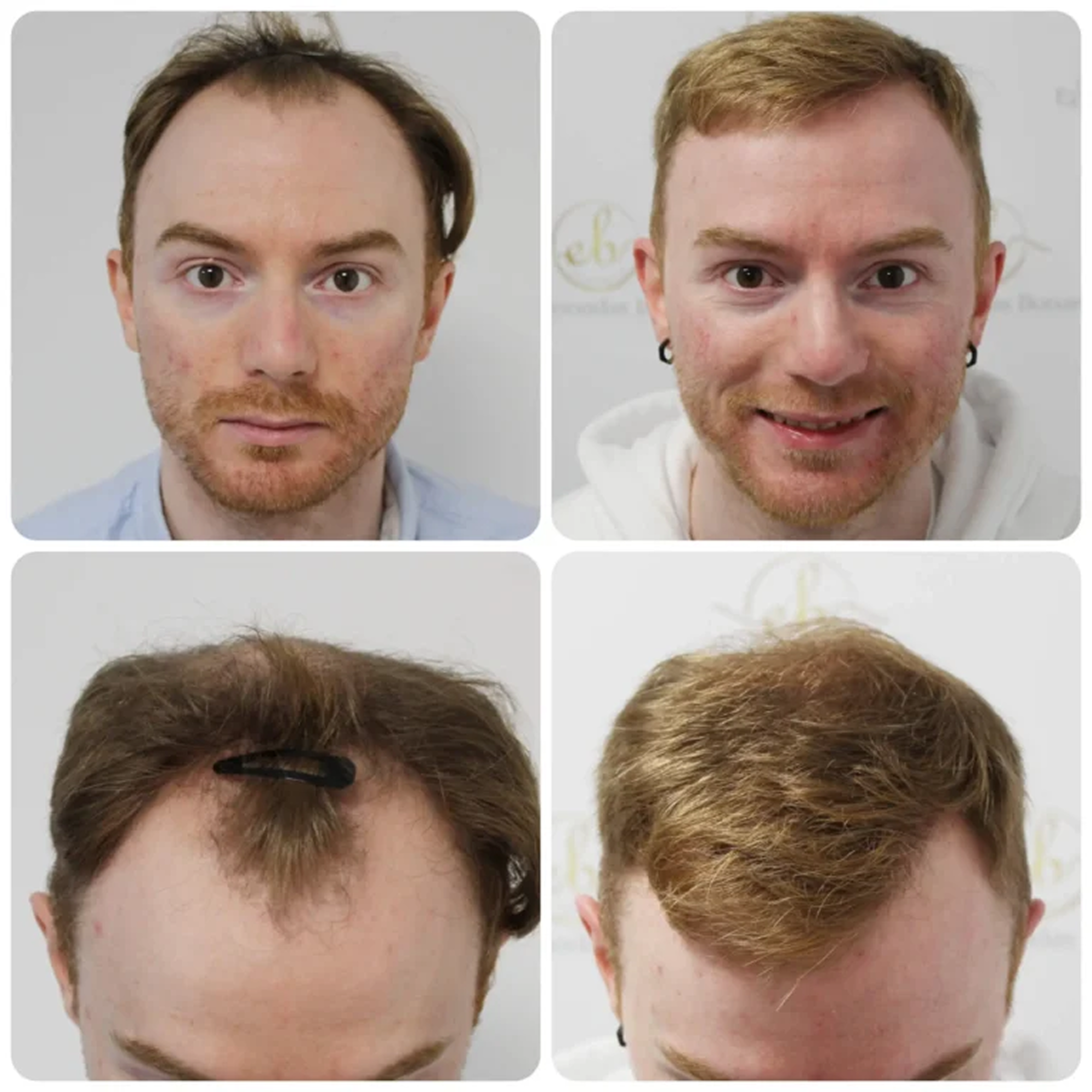 FUE procedure with 3,641 grafts