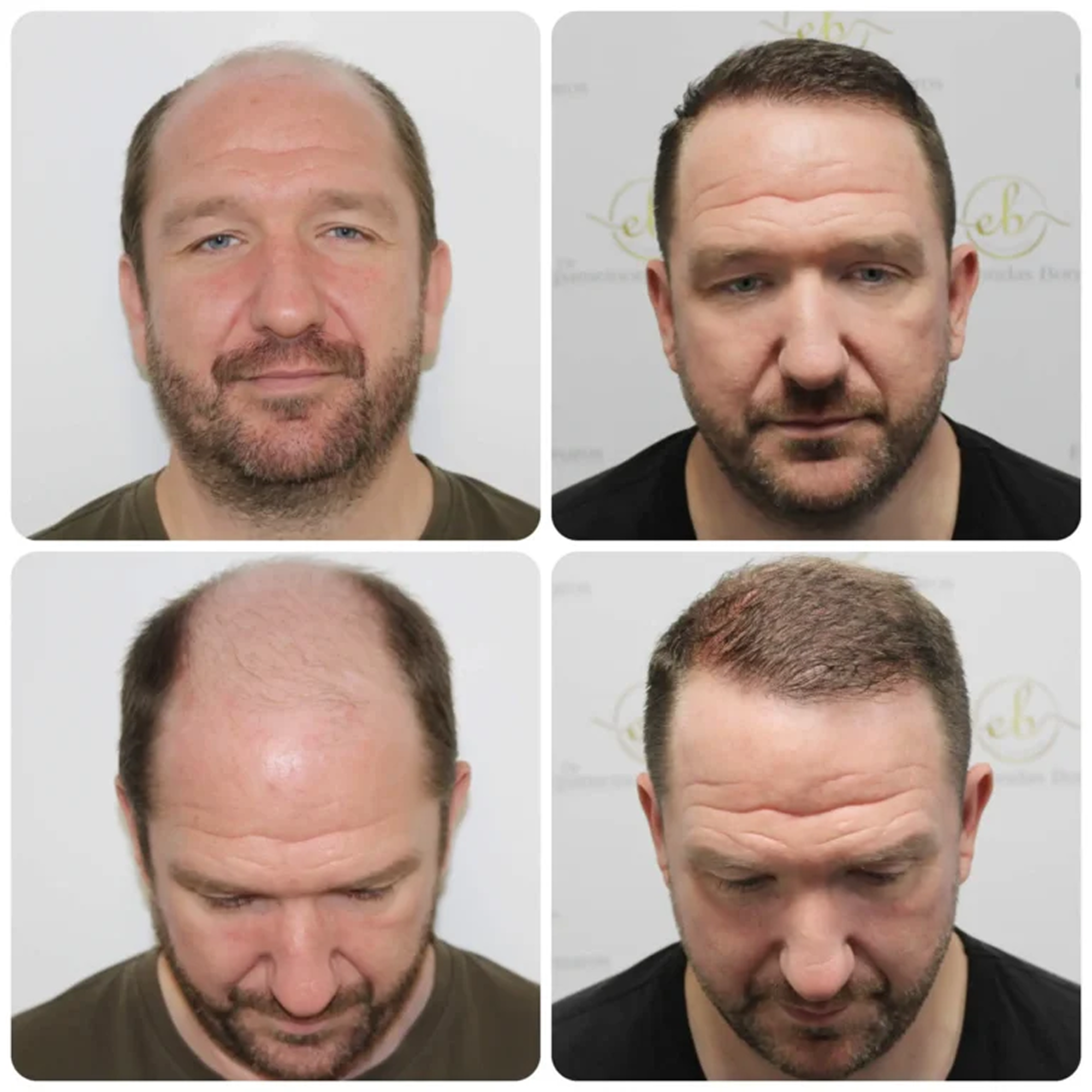 FUE hair transplant with 3,796 grafts