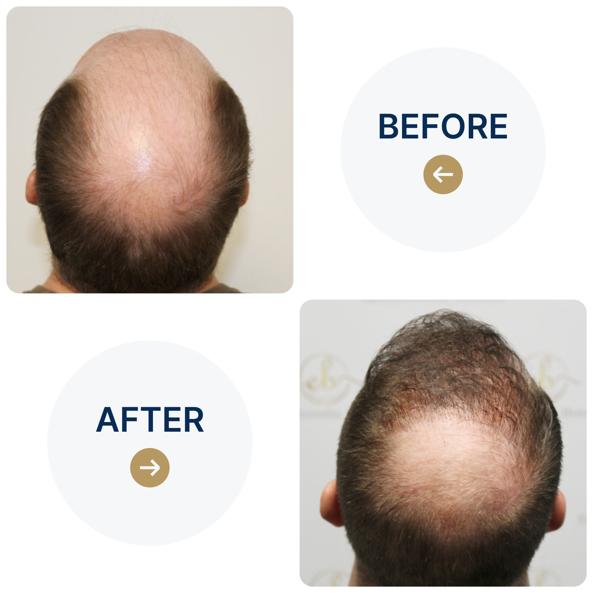 FUE hair transplant with 3,796 grafts