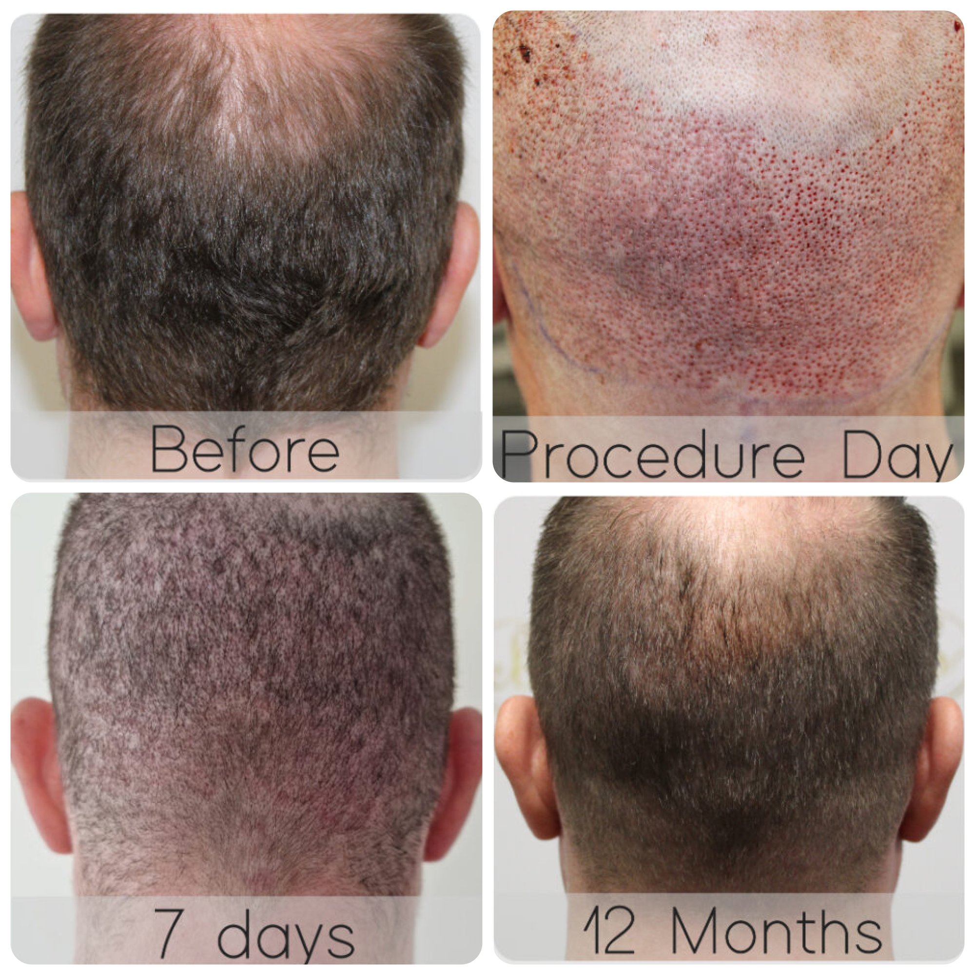 FUE hair transplant with 3,796 grafts