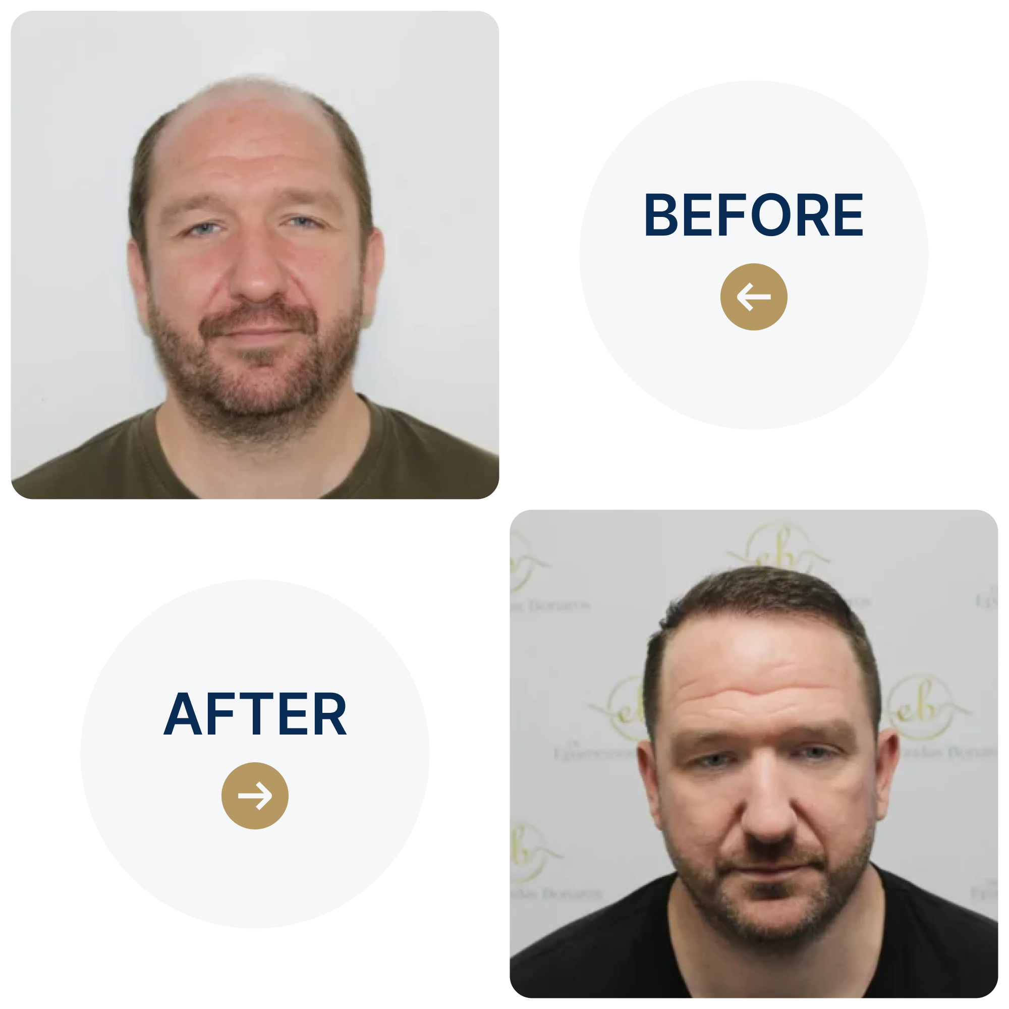 FUE hair transplant with 3,796 grafts